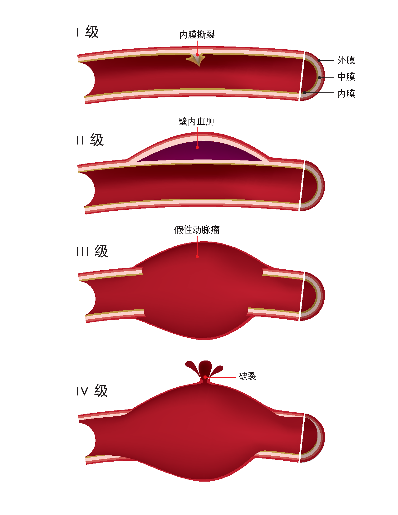 Aneurysms