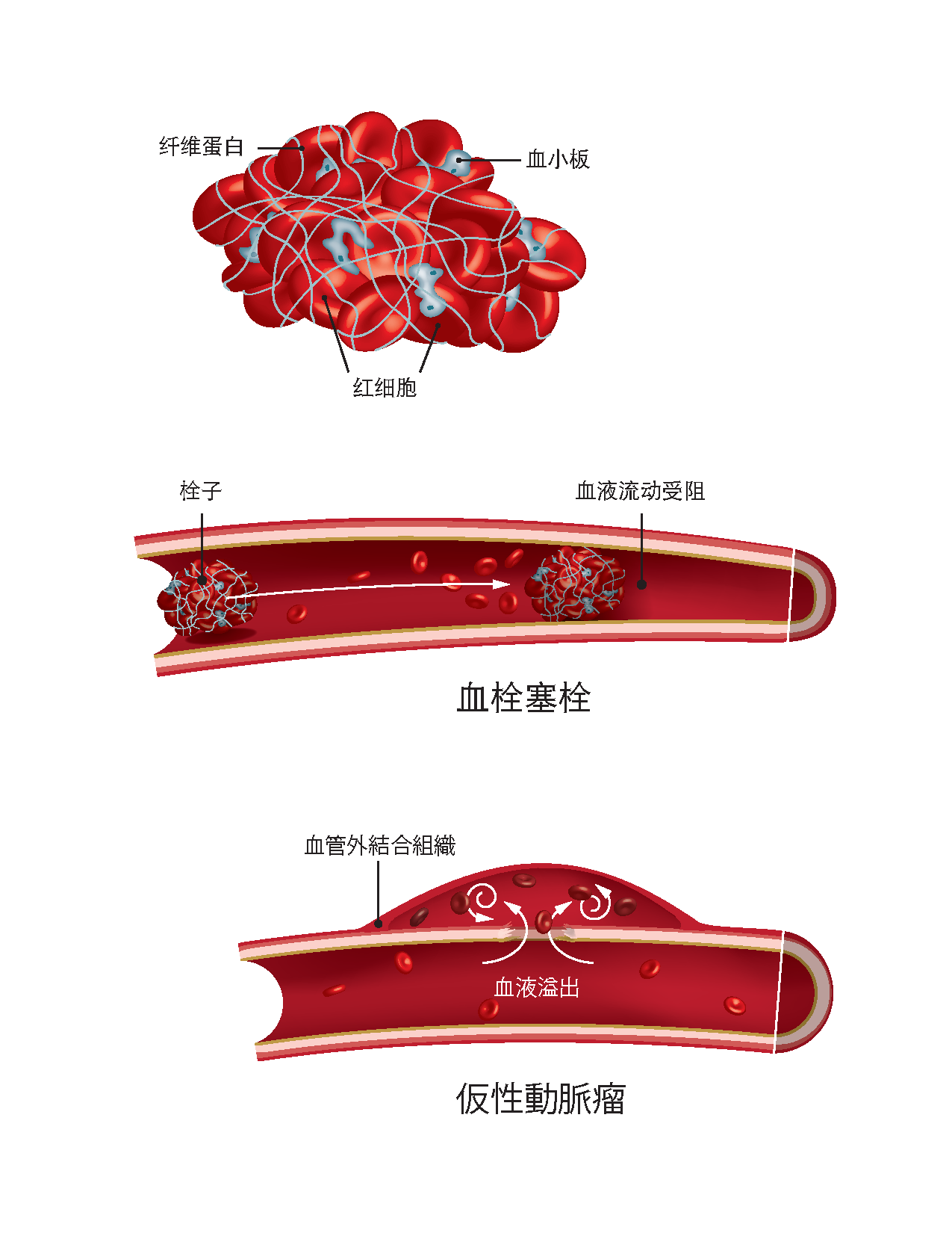 Blood clot