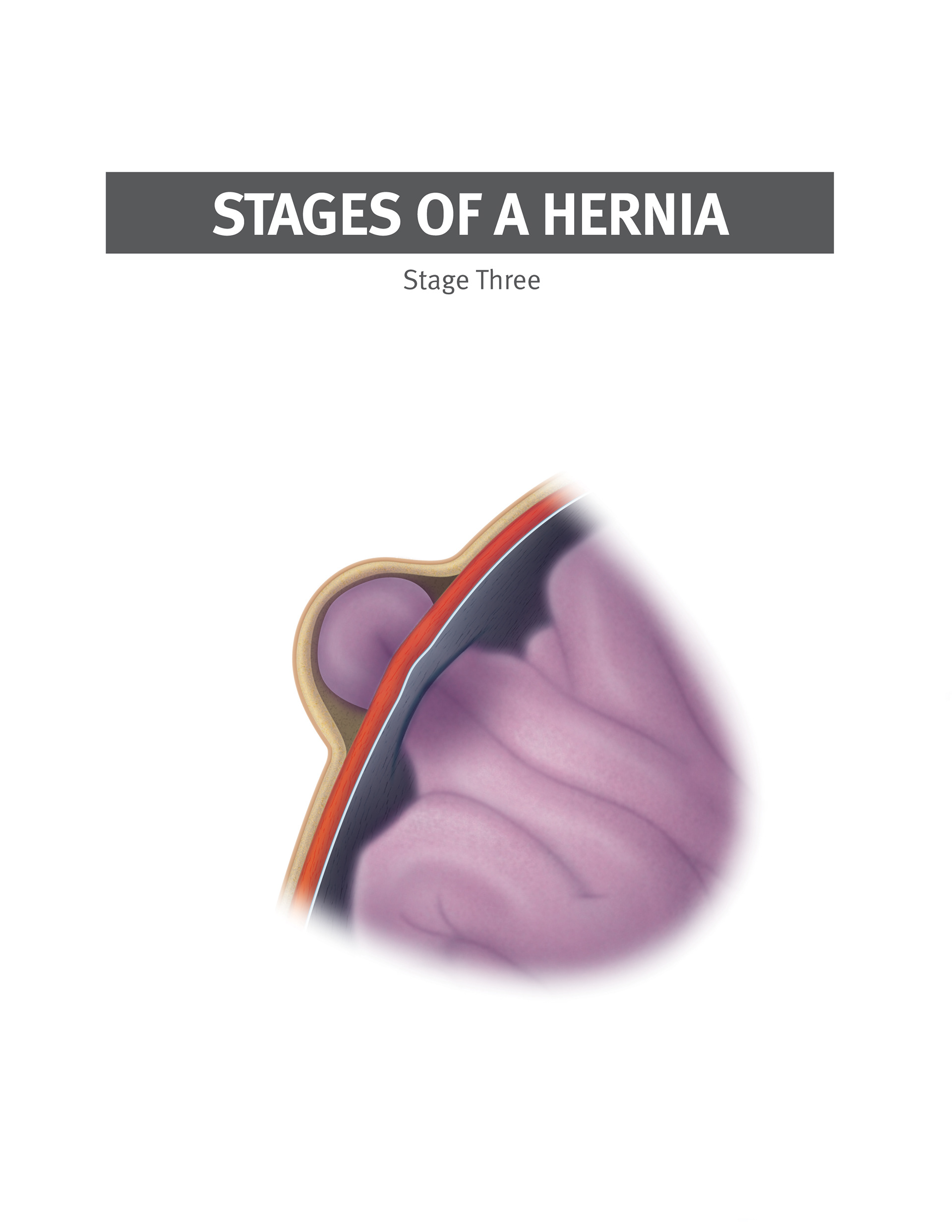 can you cycle with a hernia