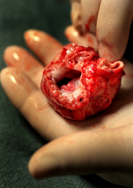 A doctor holds a baby donor's heart as he prepares to implant it into a baby recipient suffering from a congenital heart defect. 