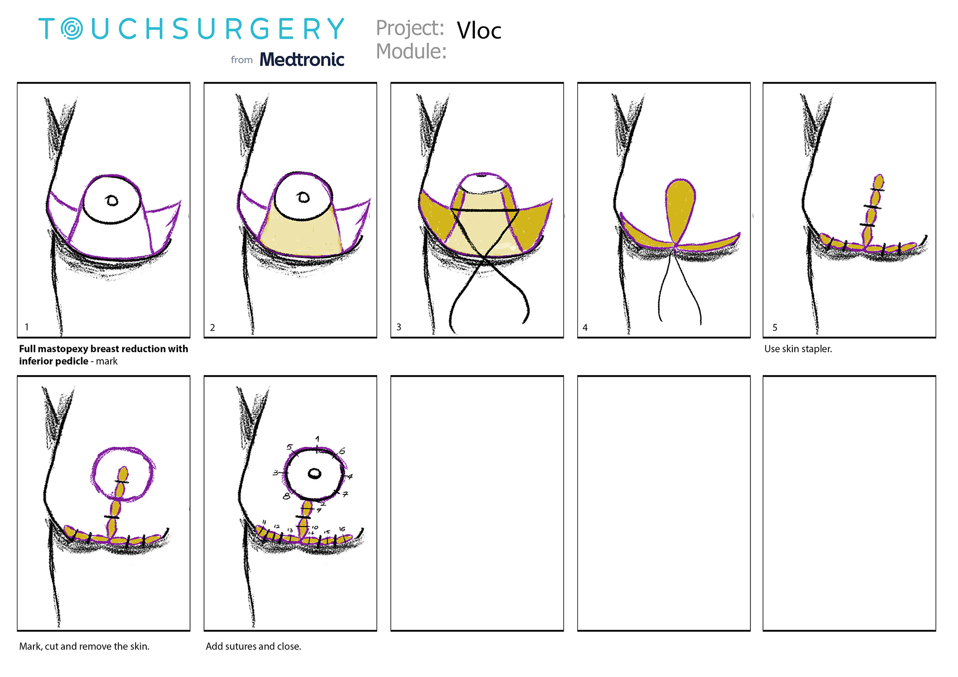 Storyboard for mastectomy.
