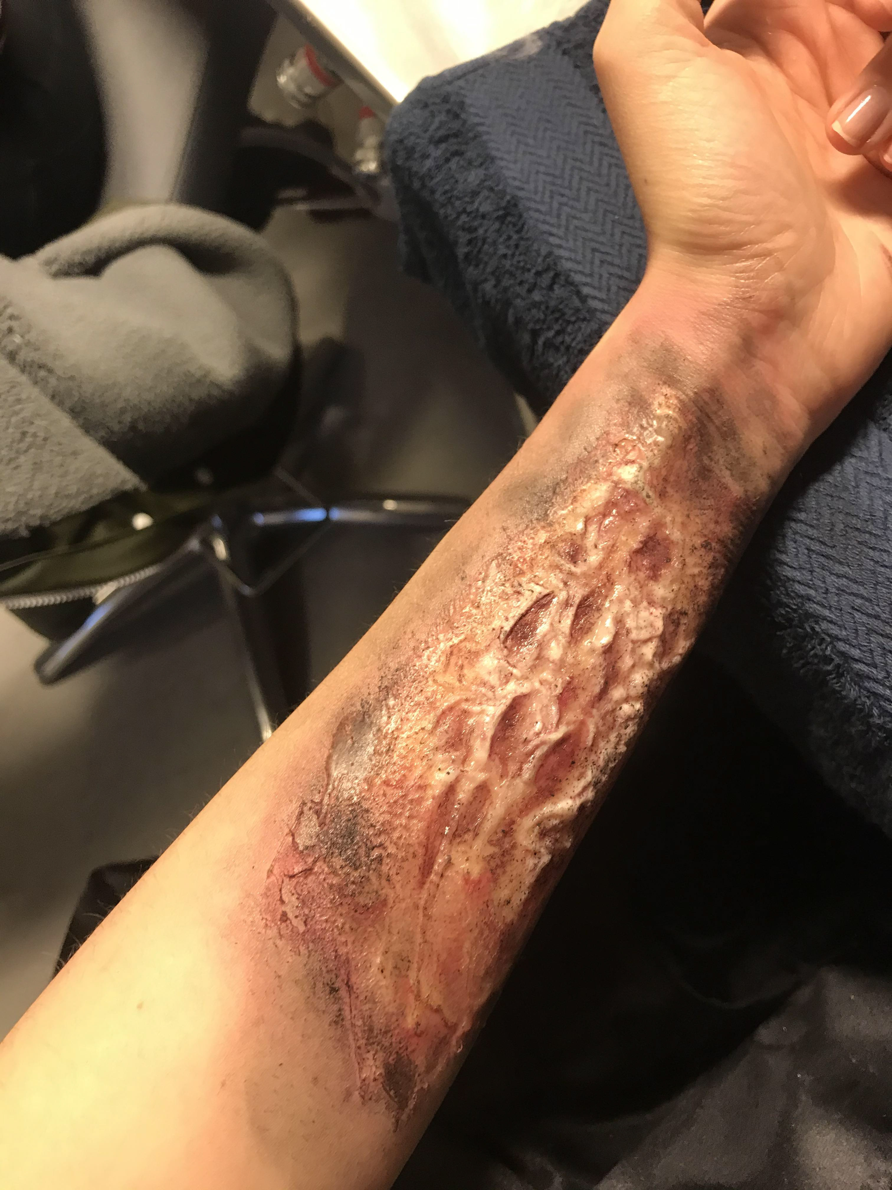 Gelatin application, burn wound