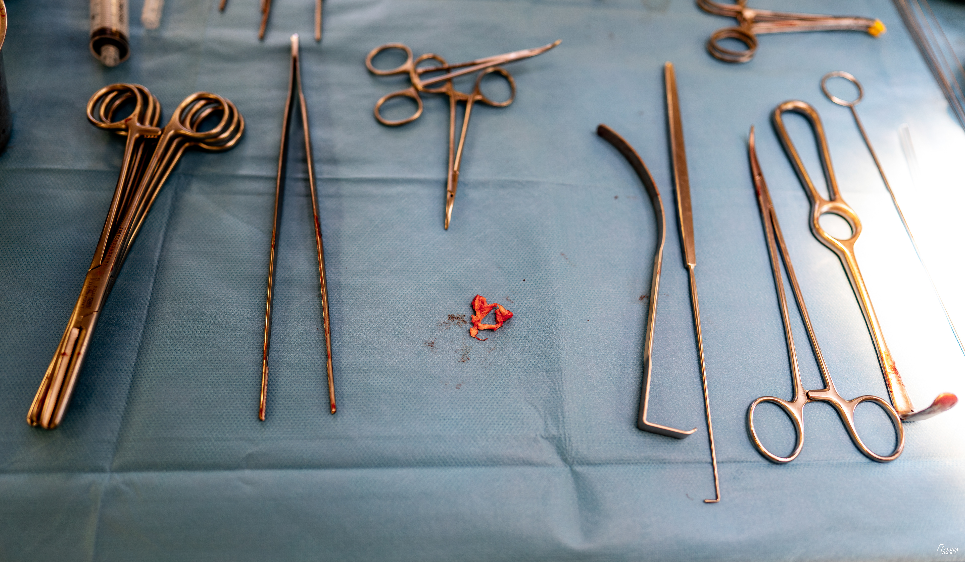     Surgically removed tissue