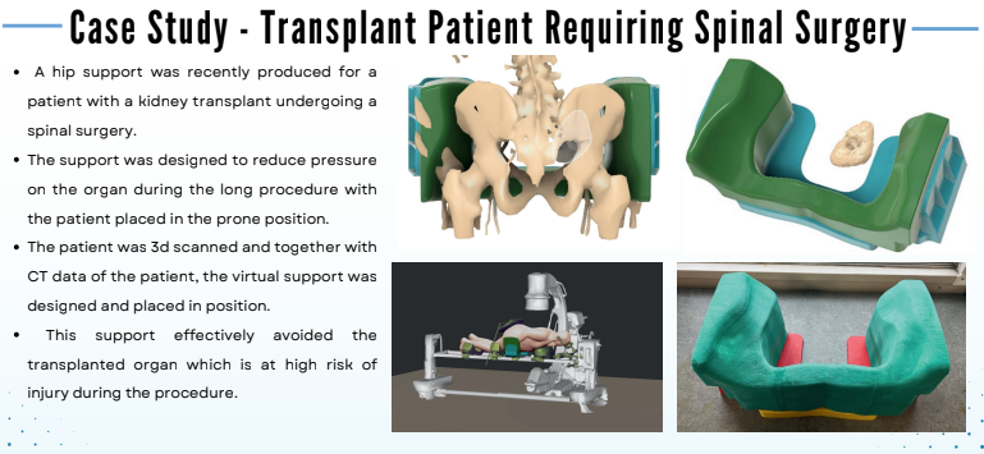 3D scan of patient, operating table, C arm Xray and off the shelf cusions to make a digital theater for surgery planning. CT data converted into 3D models. Custom cusion designed for surgery supporting the hips, yet avoiding the transplant area to reduce pressure risk. 3D mould designed and printed, Silicone and foam ran all by me.