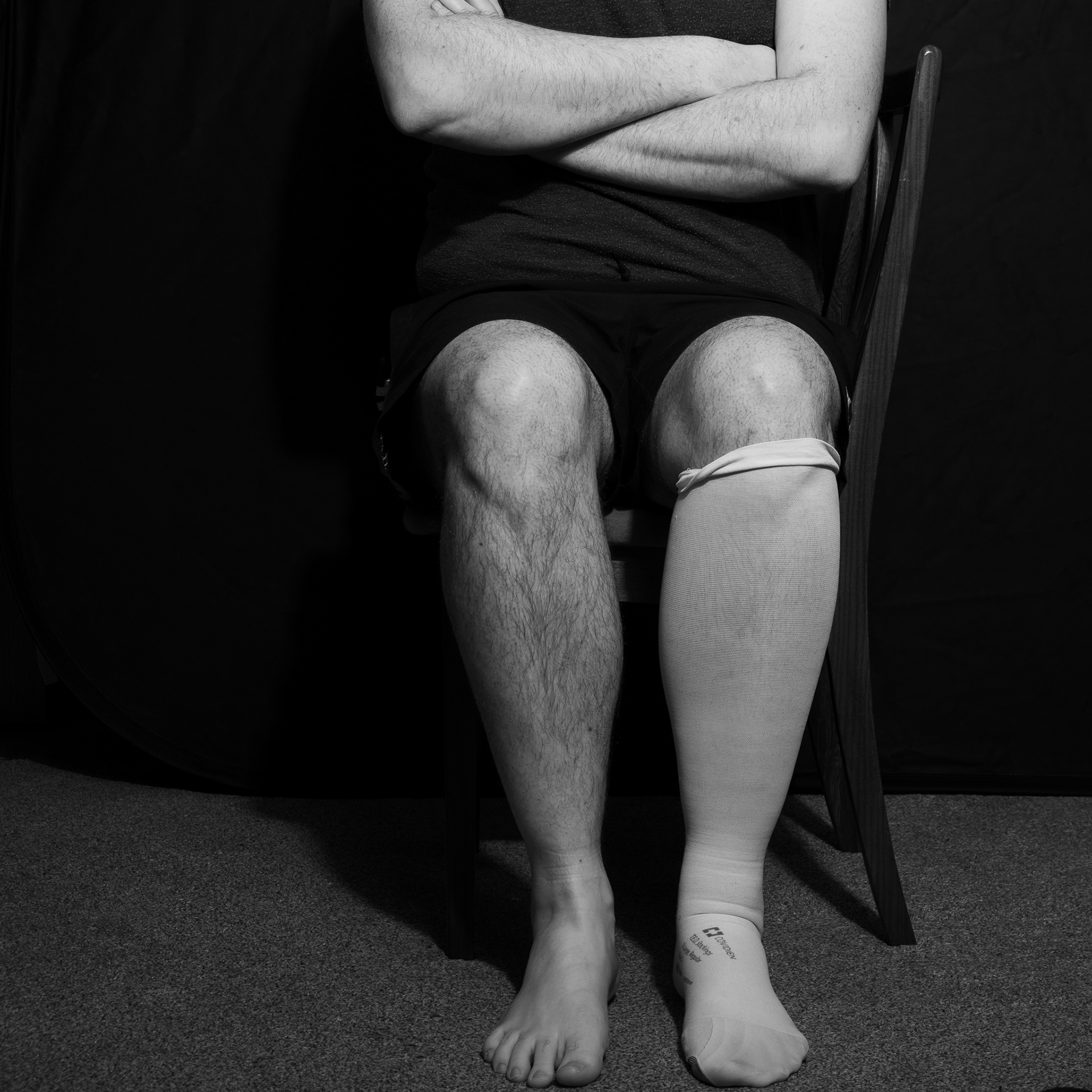 DVT: Compression stocking