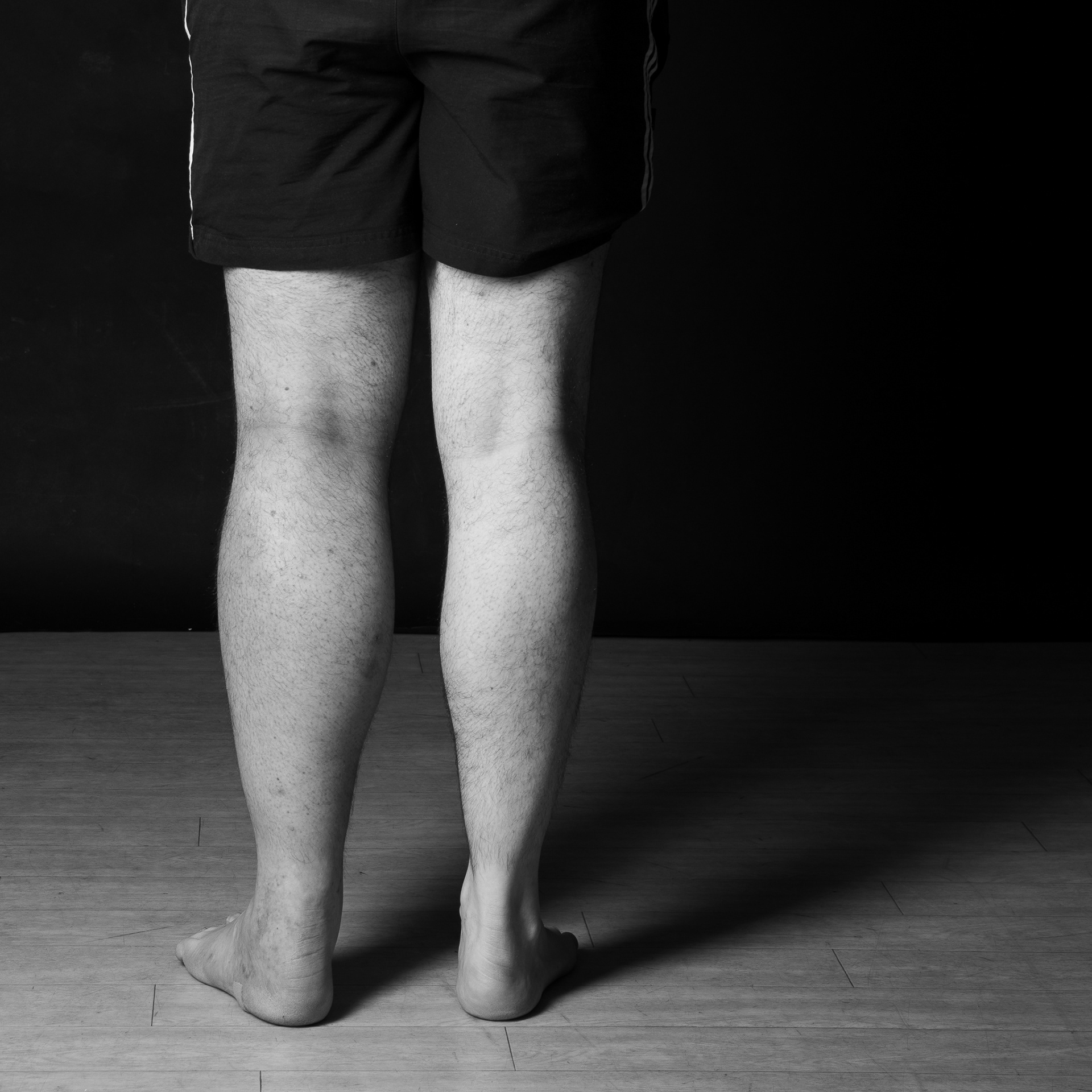 DVT: Swollen red leg