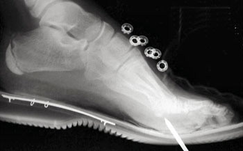 One of the major problems in urban operations was soldiers being routinely injured by stepping on nails. We sought to find a material that would be flexible and puncture proof to help avoid injuries.