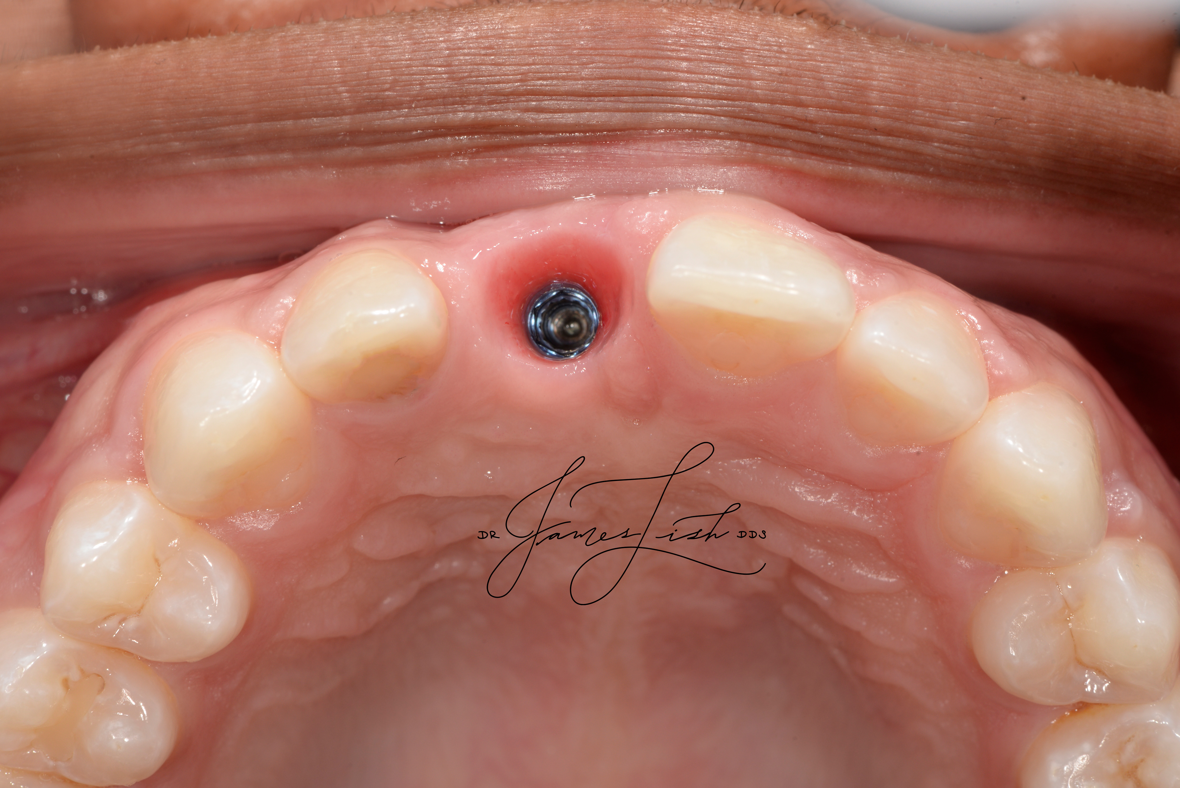 Beautiful tissue health around implant