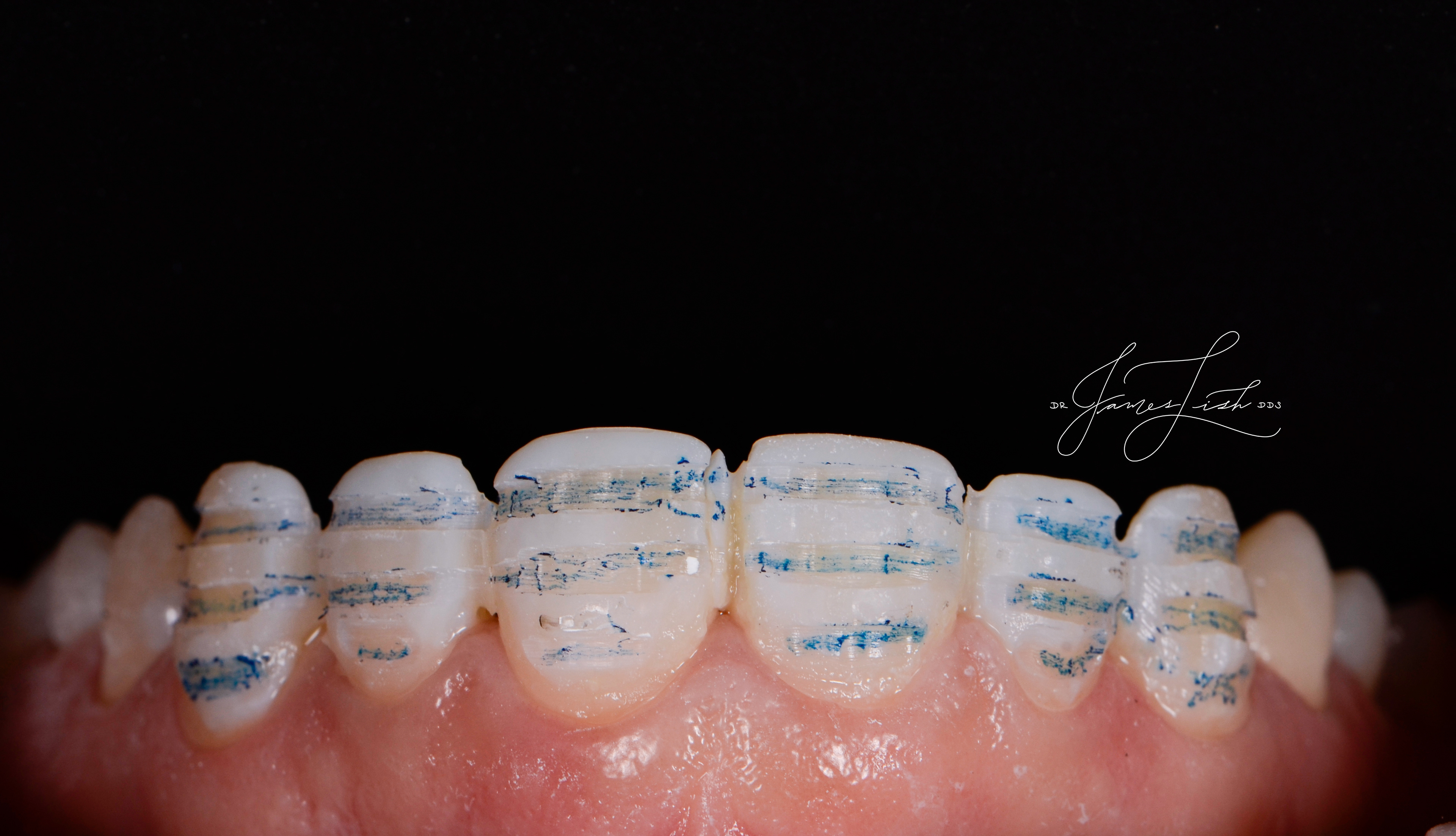Reduction marking lines for precise veneer shaping