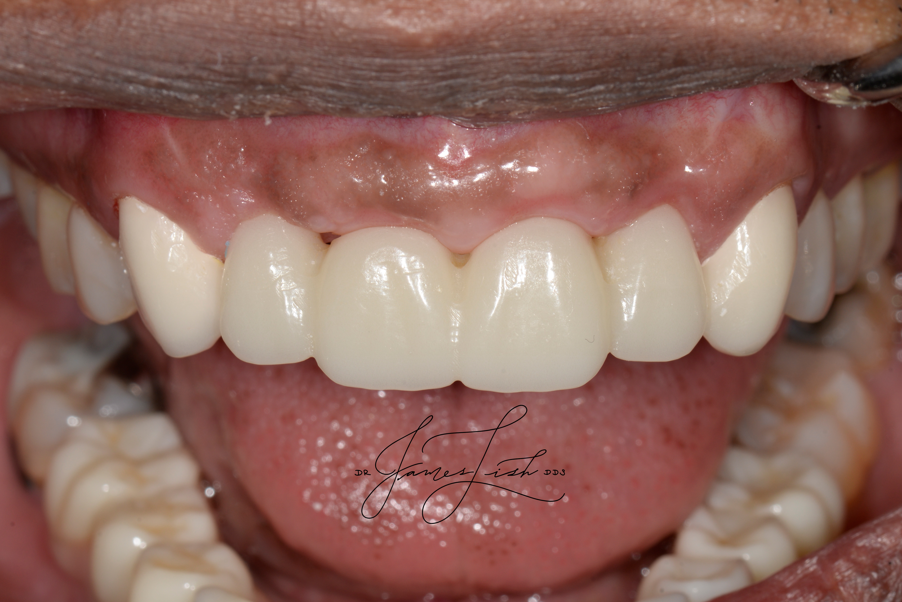 Mid Treatment Temporaries