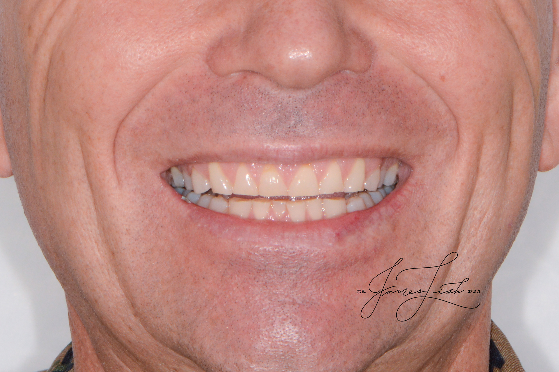 Initial Situation - Full mouth wear and erosion
