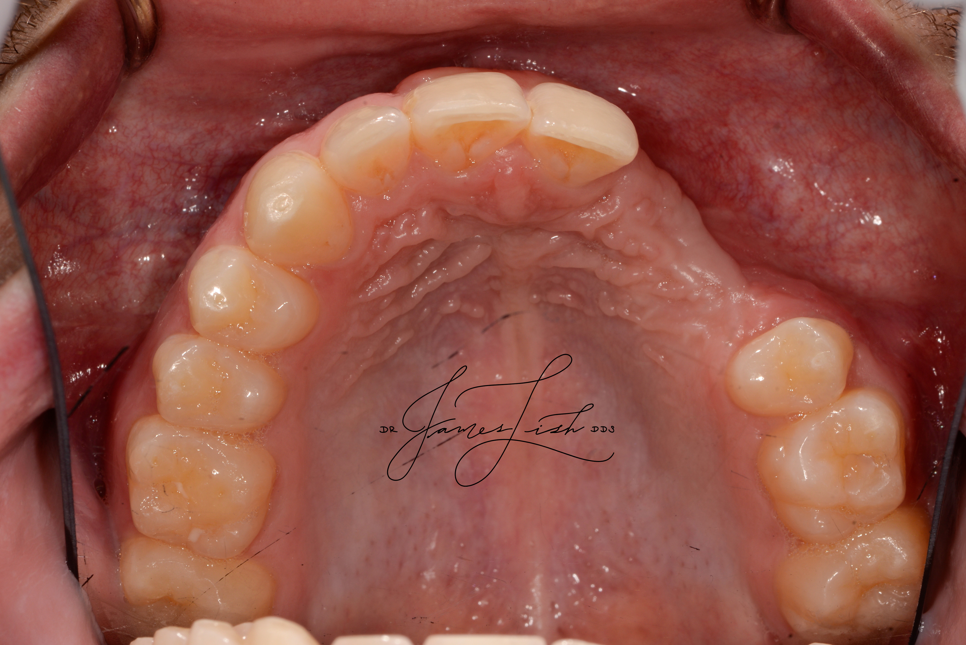 Initial Situation After Tumor Removal