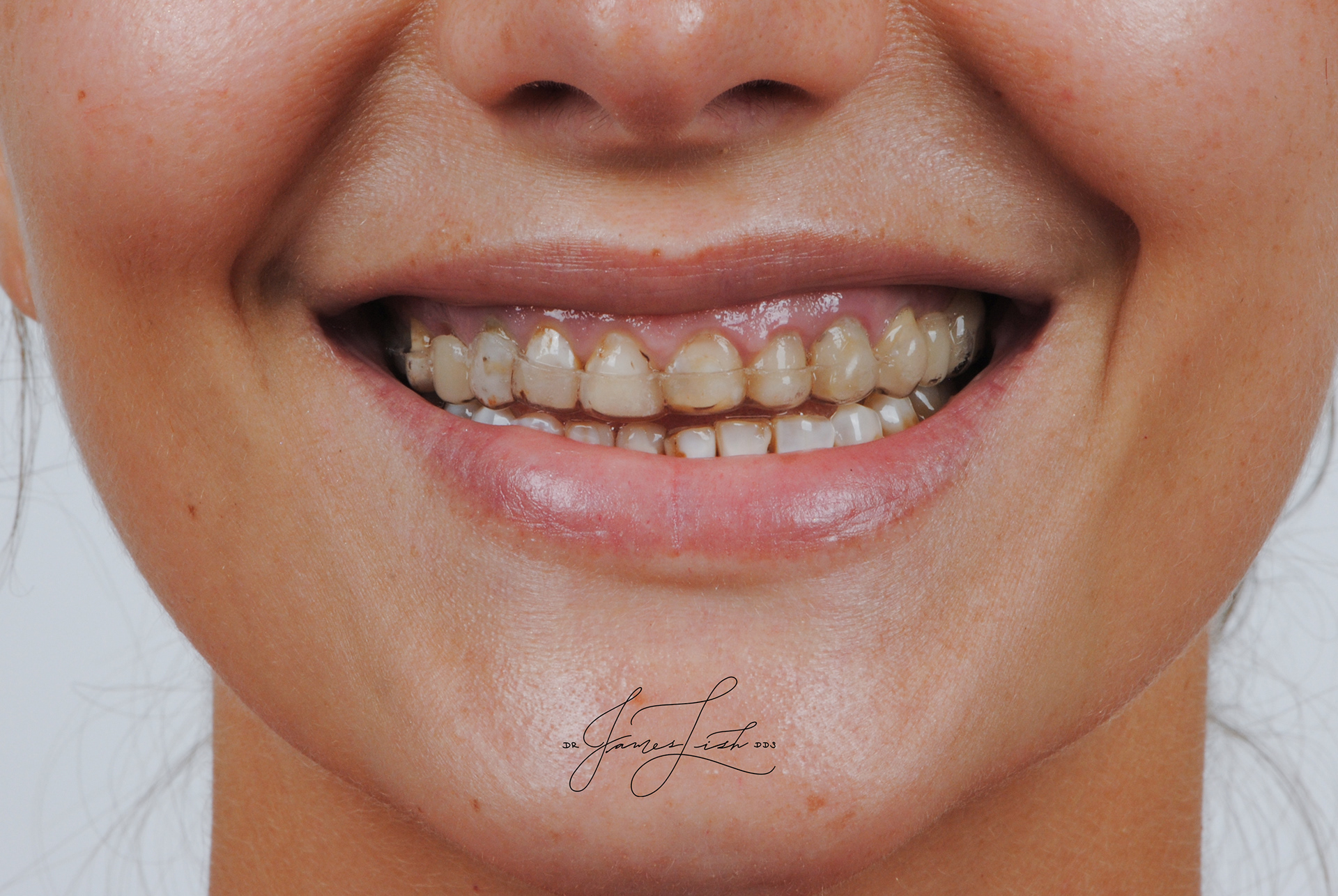 Initial Smile