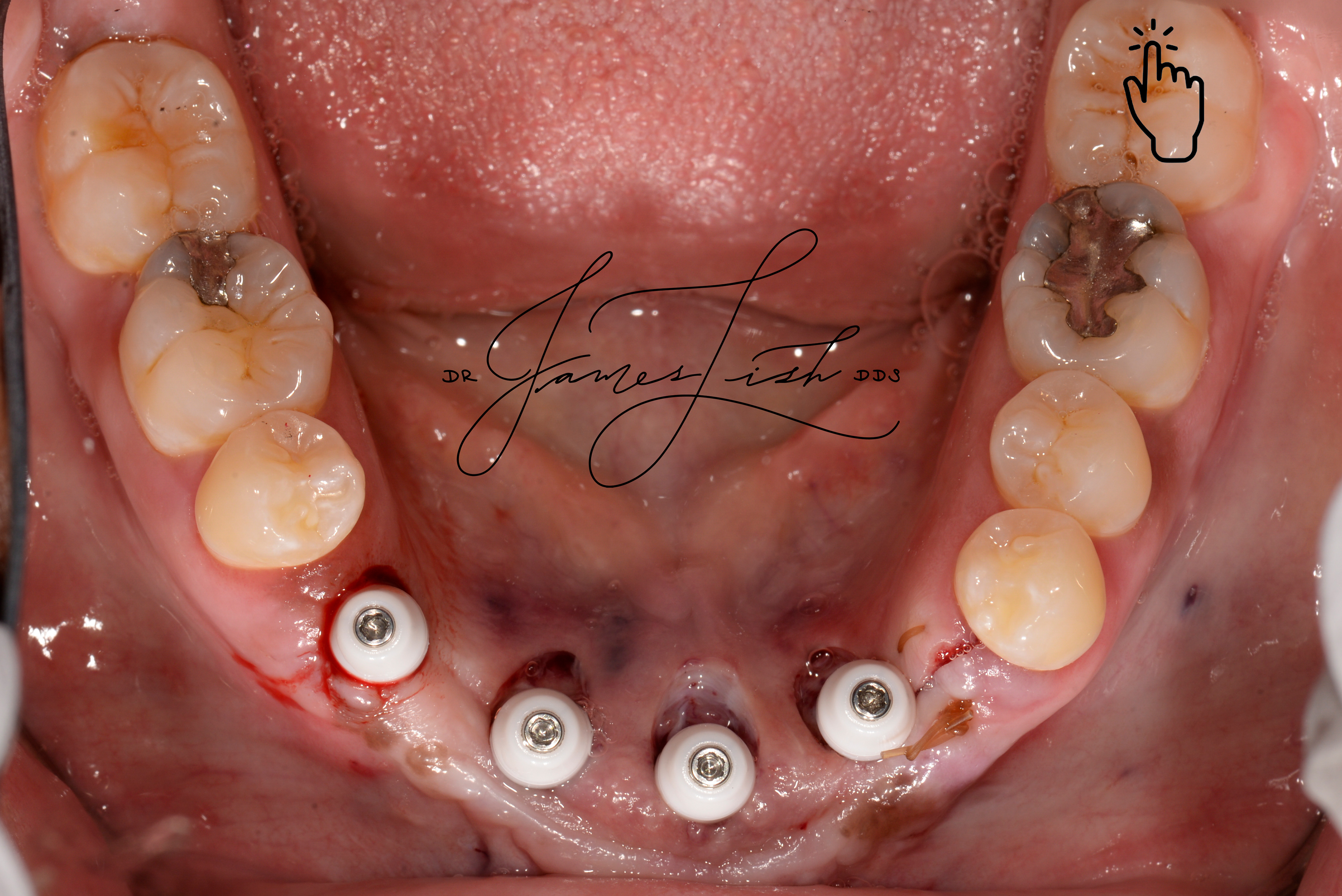 Situation after removal, grafting and healing