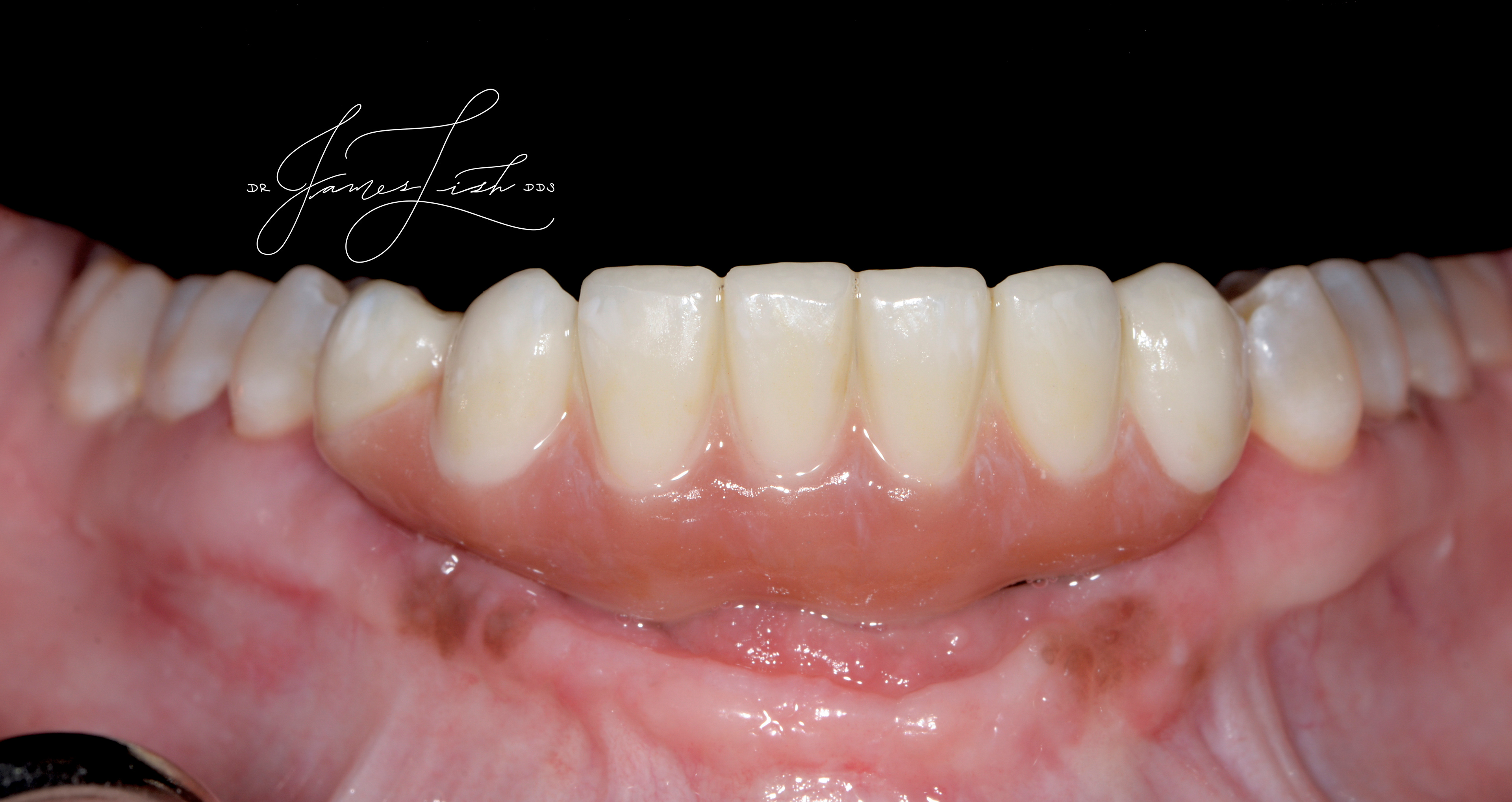 Final ceramic reconstruction