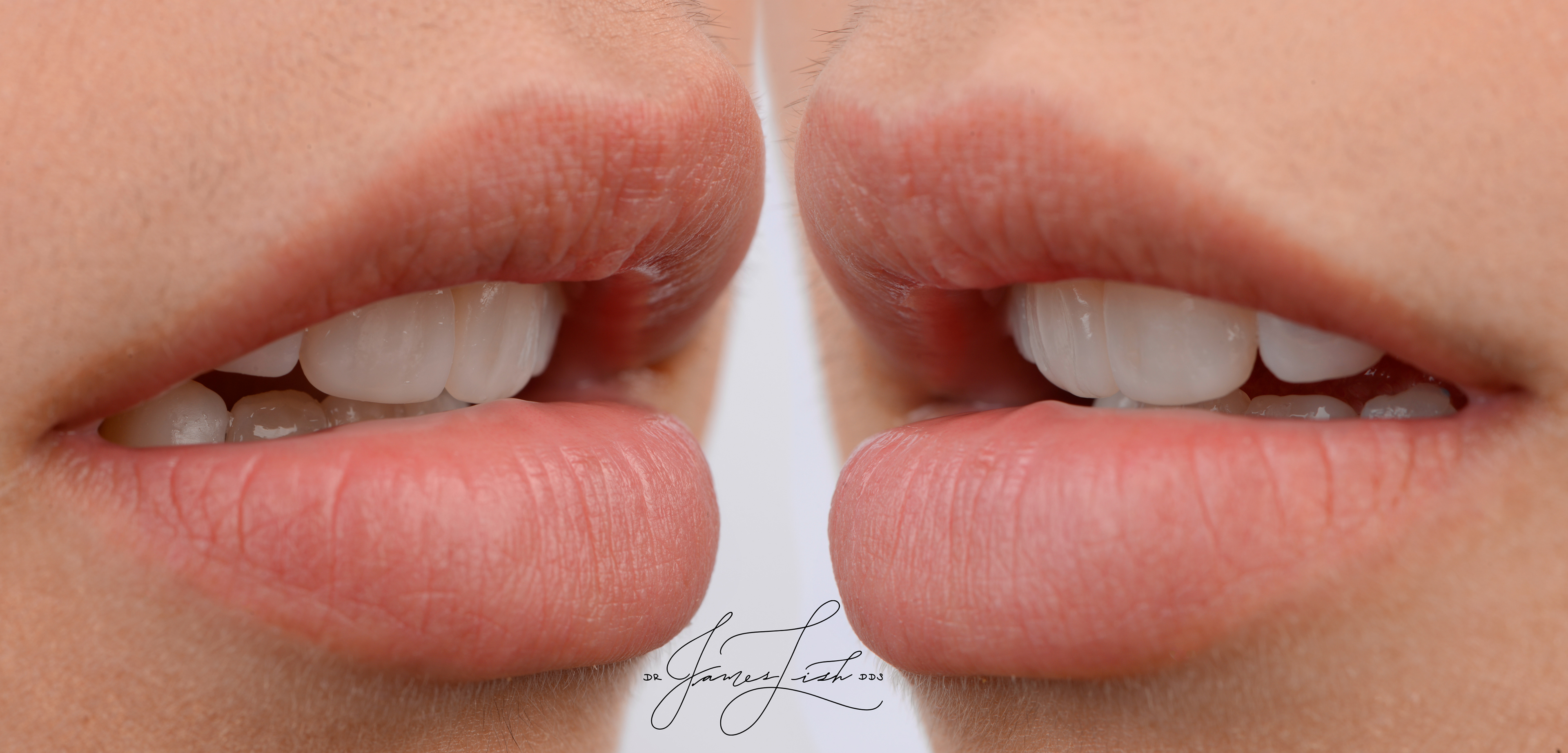 Incisal edge texture
