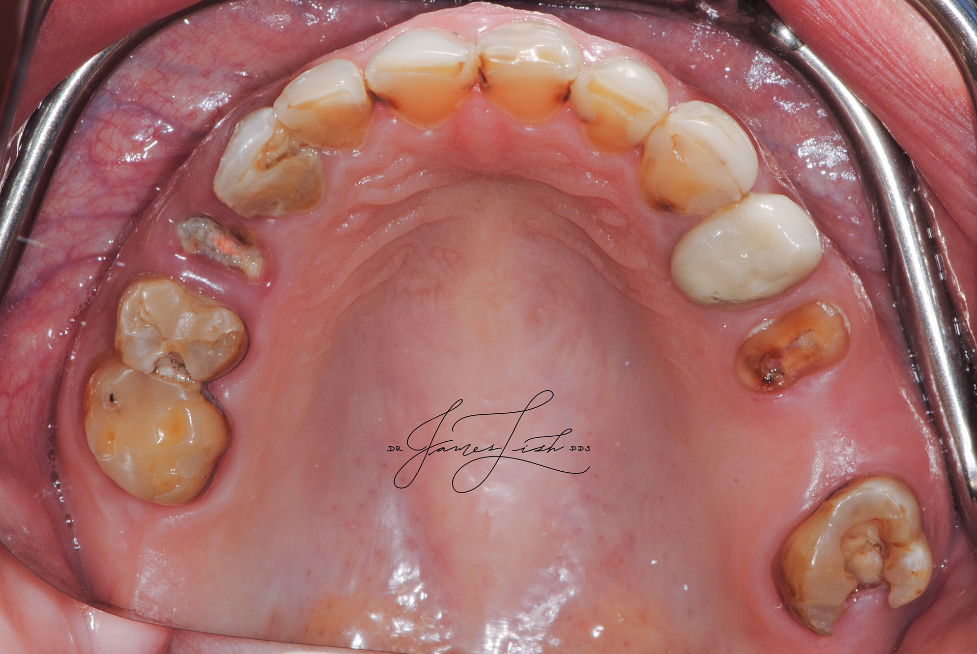 Upper Arch - Initial