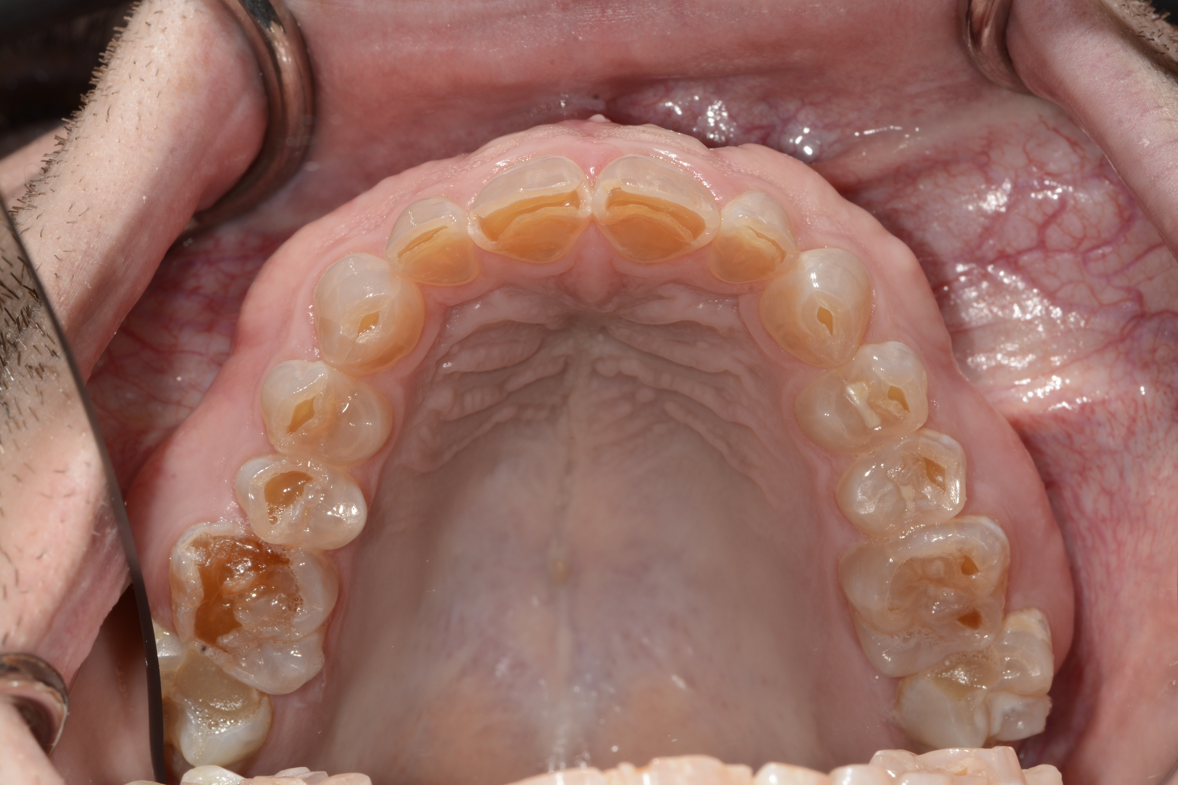 Dentogenesis Initial Upper Arch