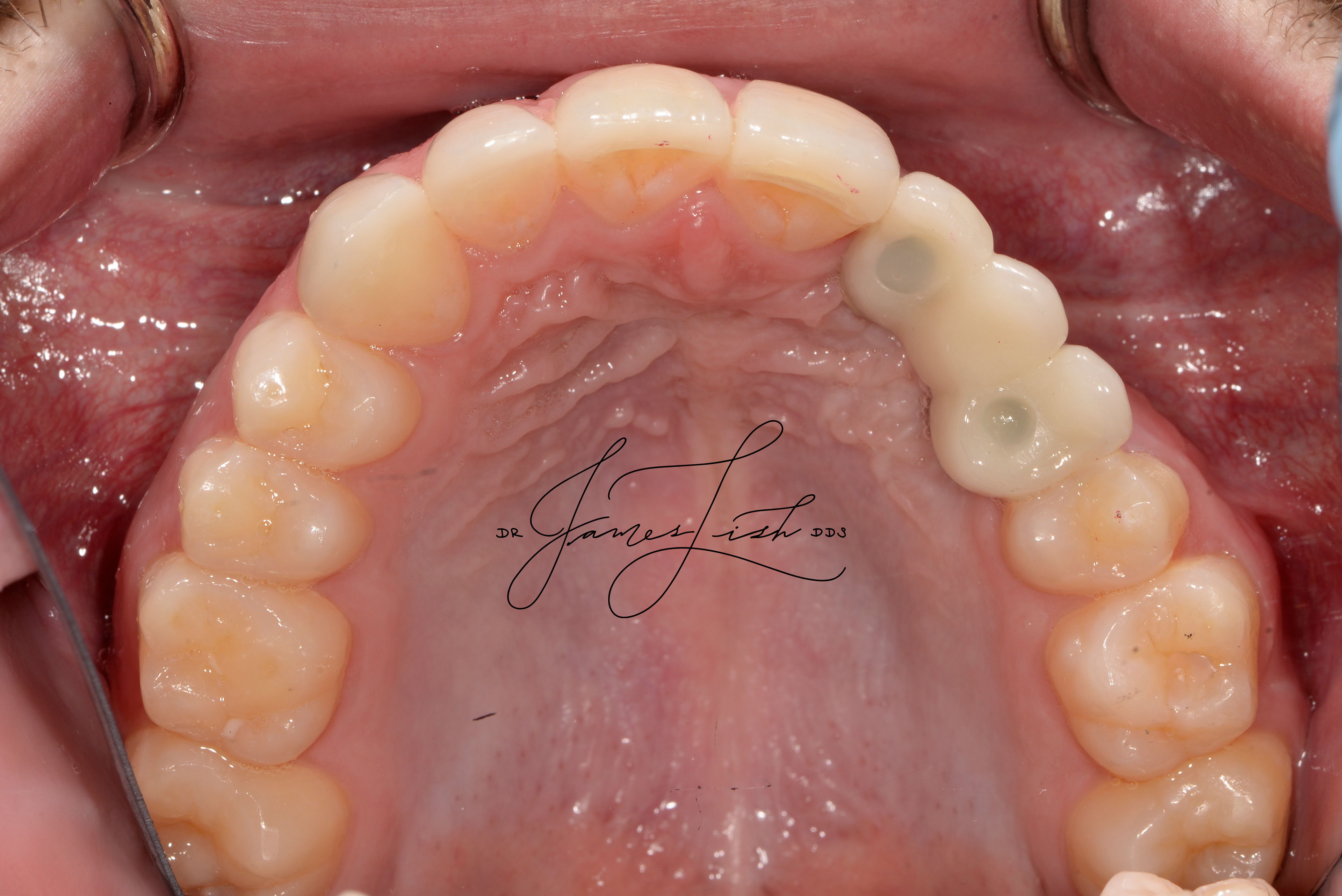 Final Implants and Ceramics