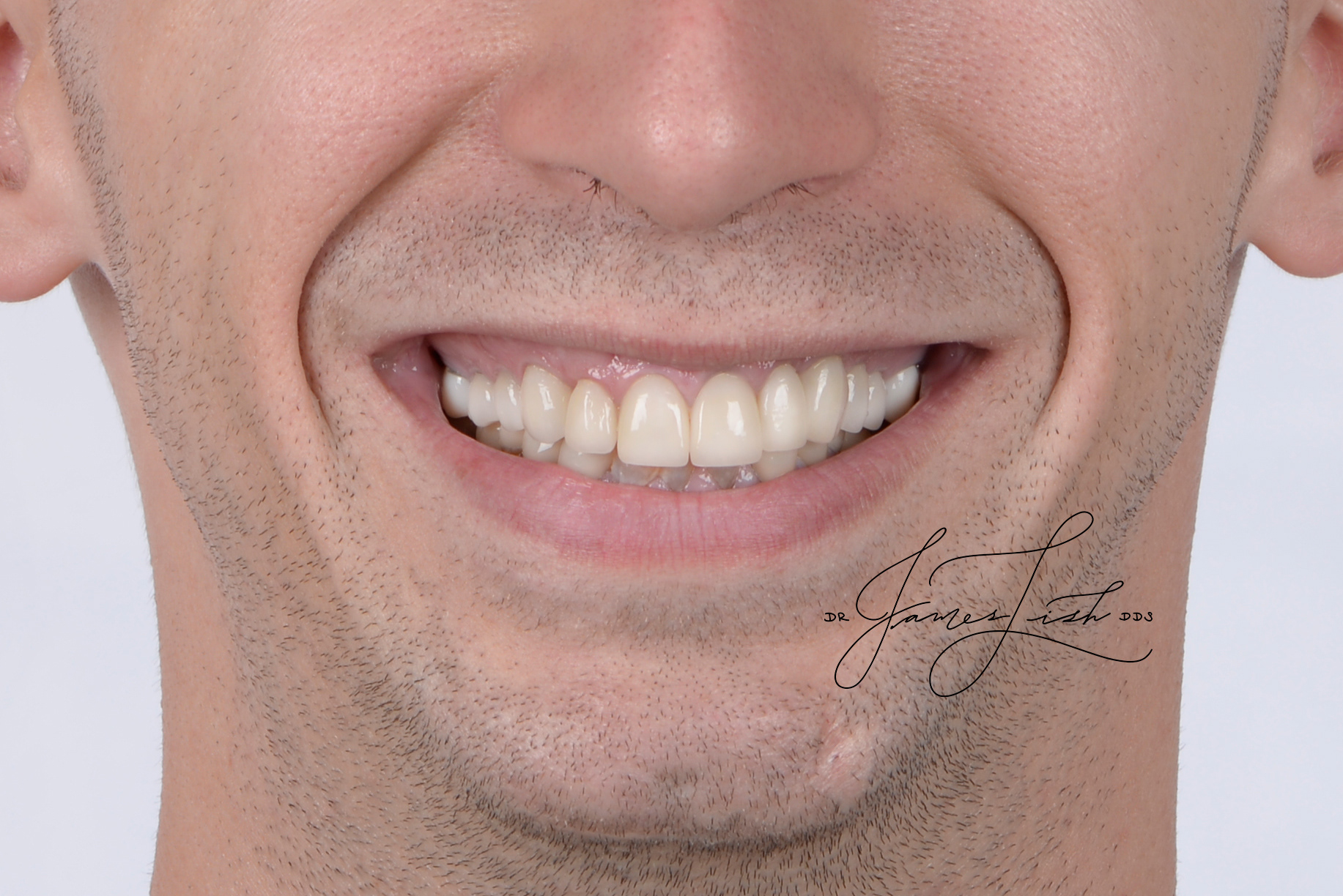 Finals - Full Smile 