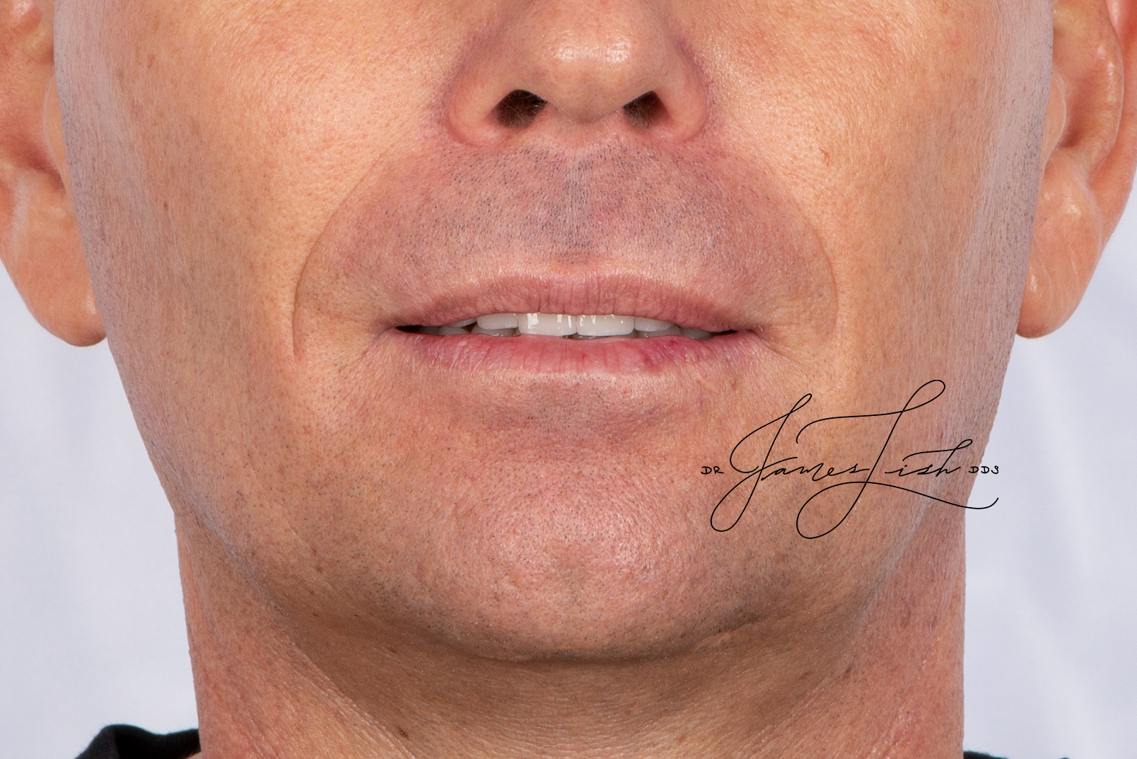 Finals - Increased smile at rest position