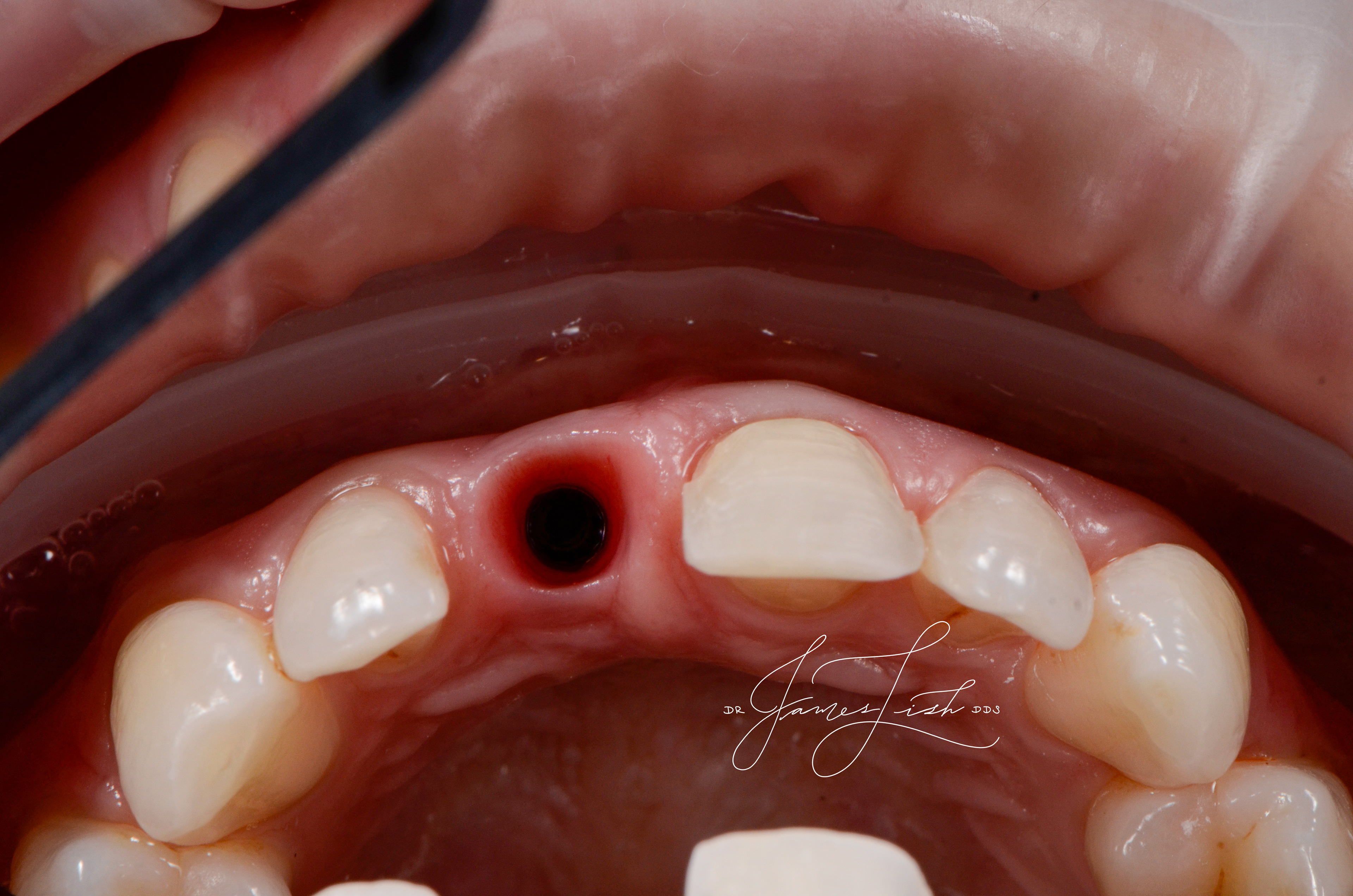 Healthy Implant tissues 