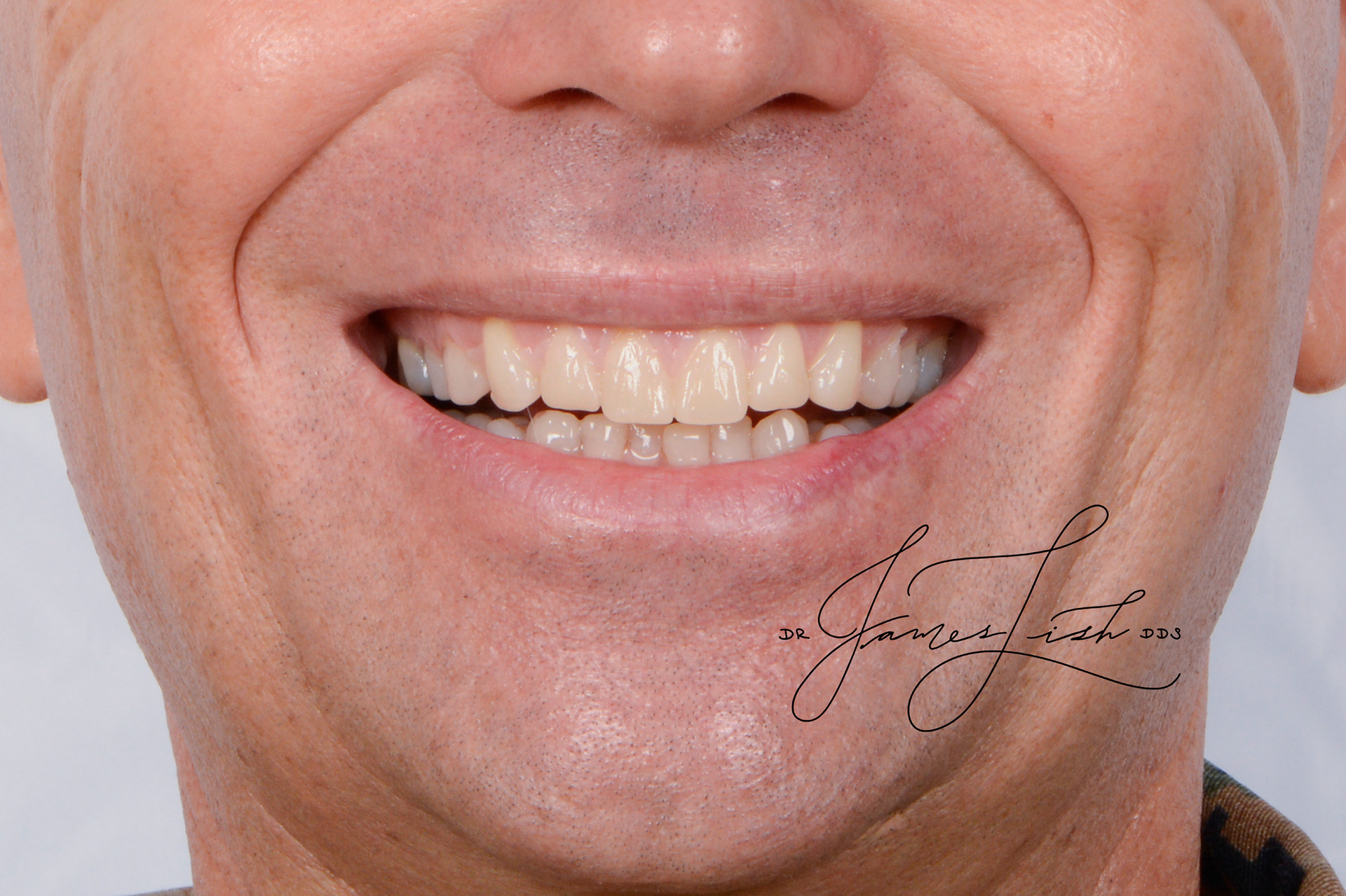 Prototype Smile Try-in