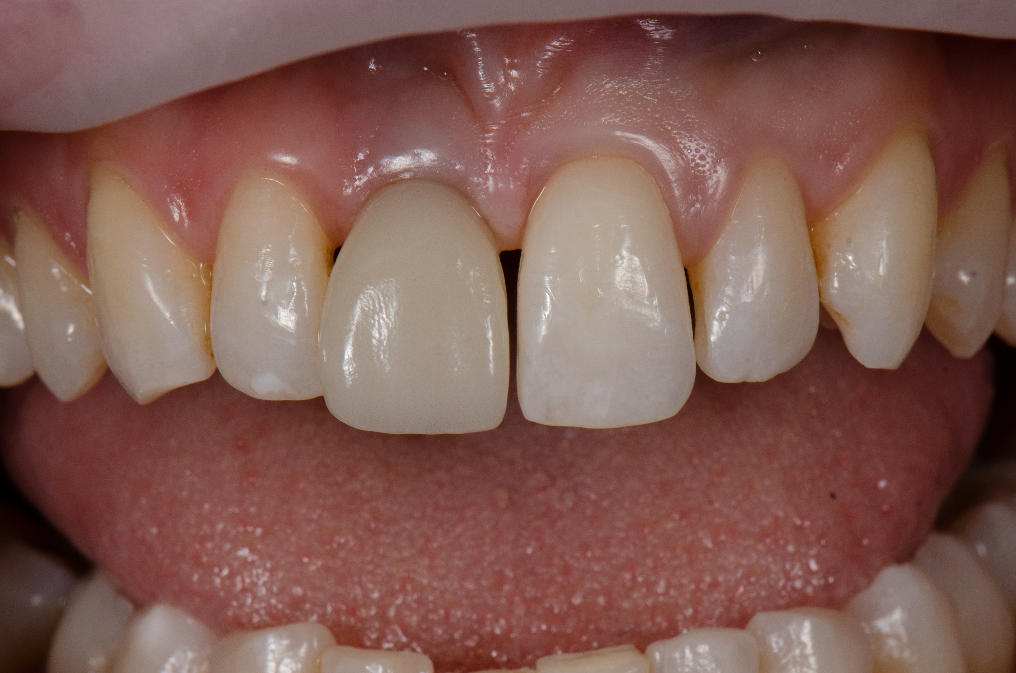 Initial After Implant Healing and Preliminary Right Temporary