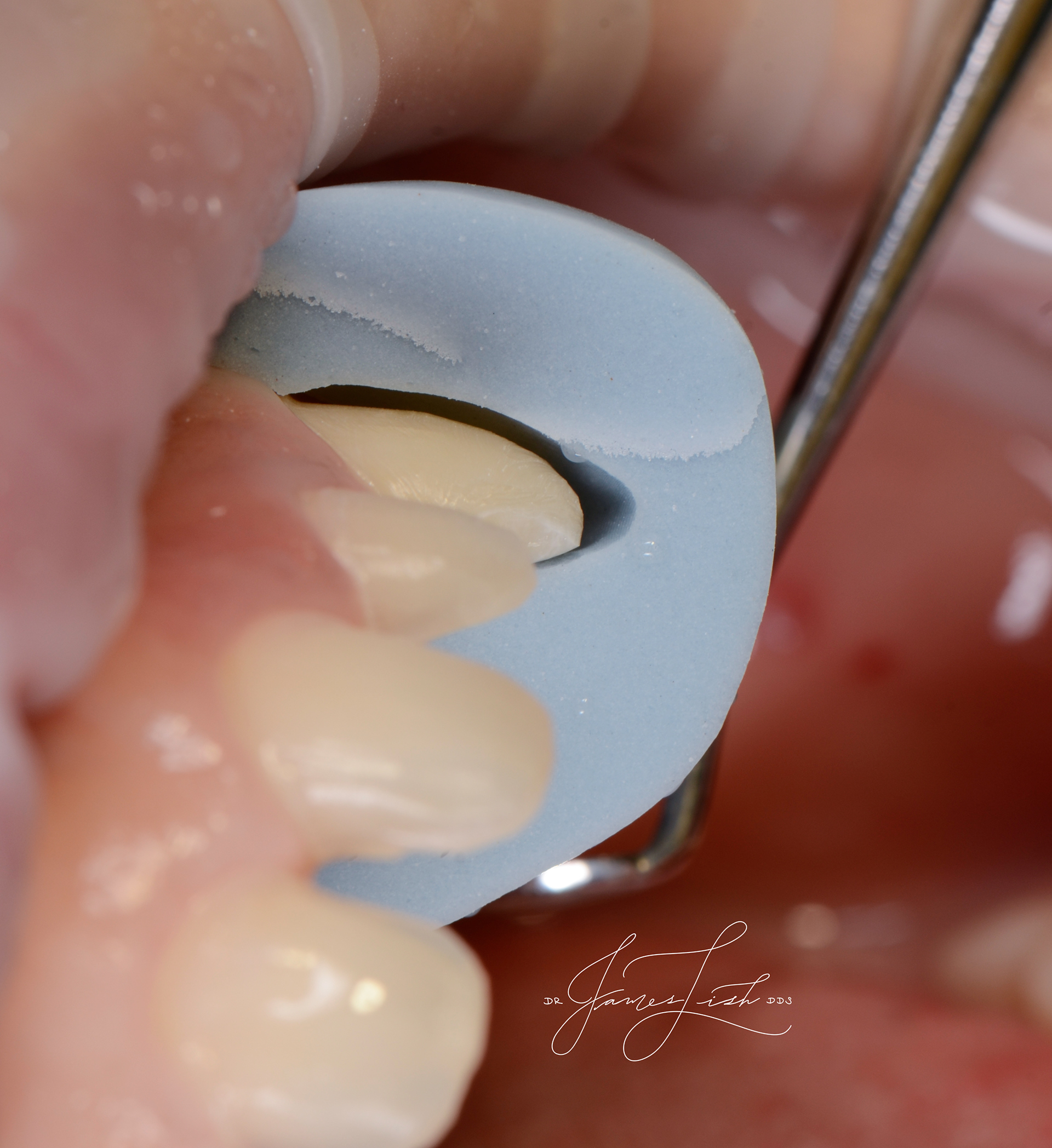Precision reduction guide