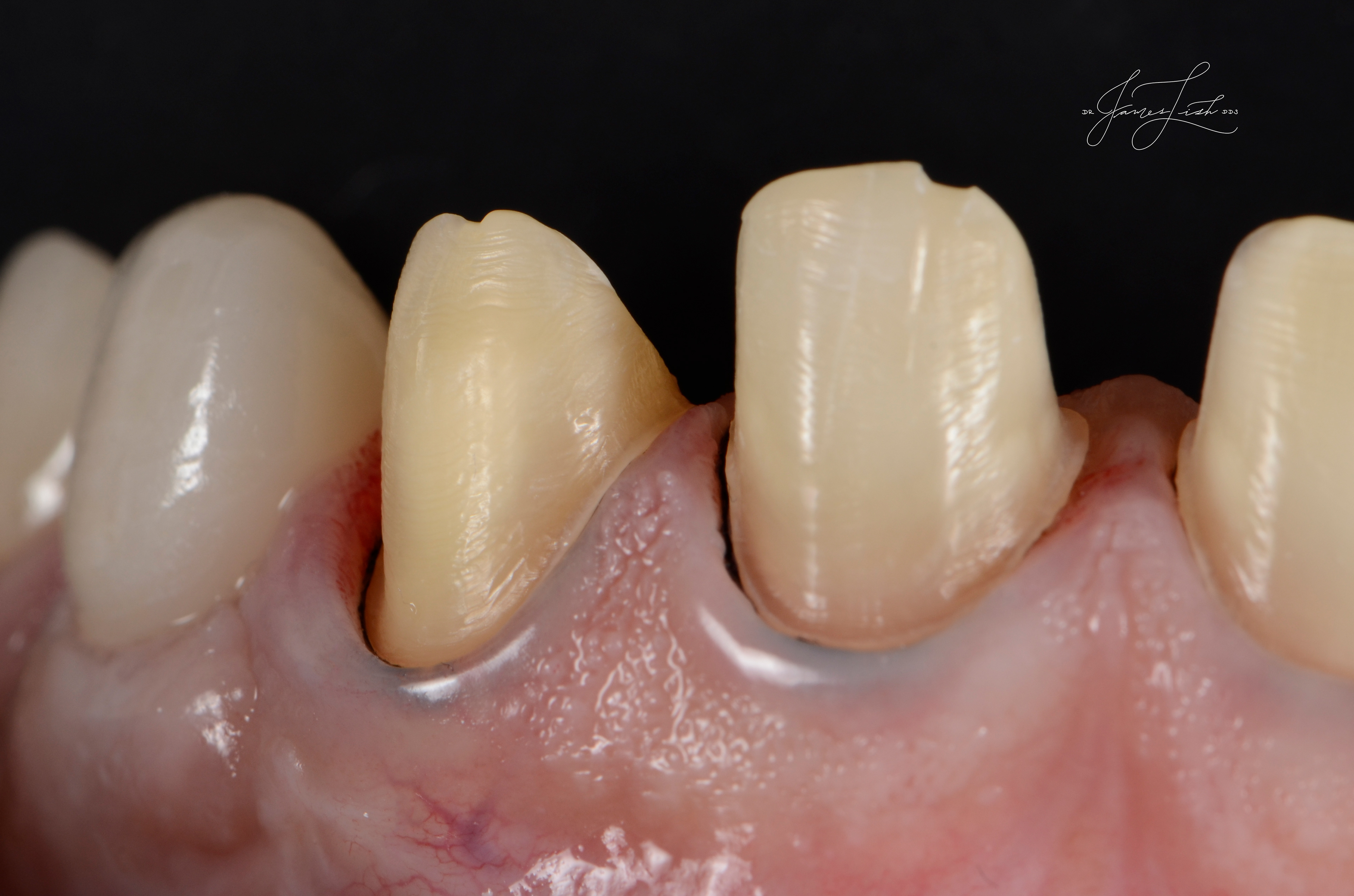 Gorgeous tissue health from high quality temporary prototypes