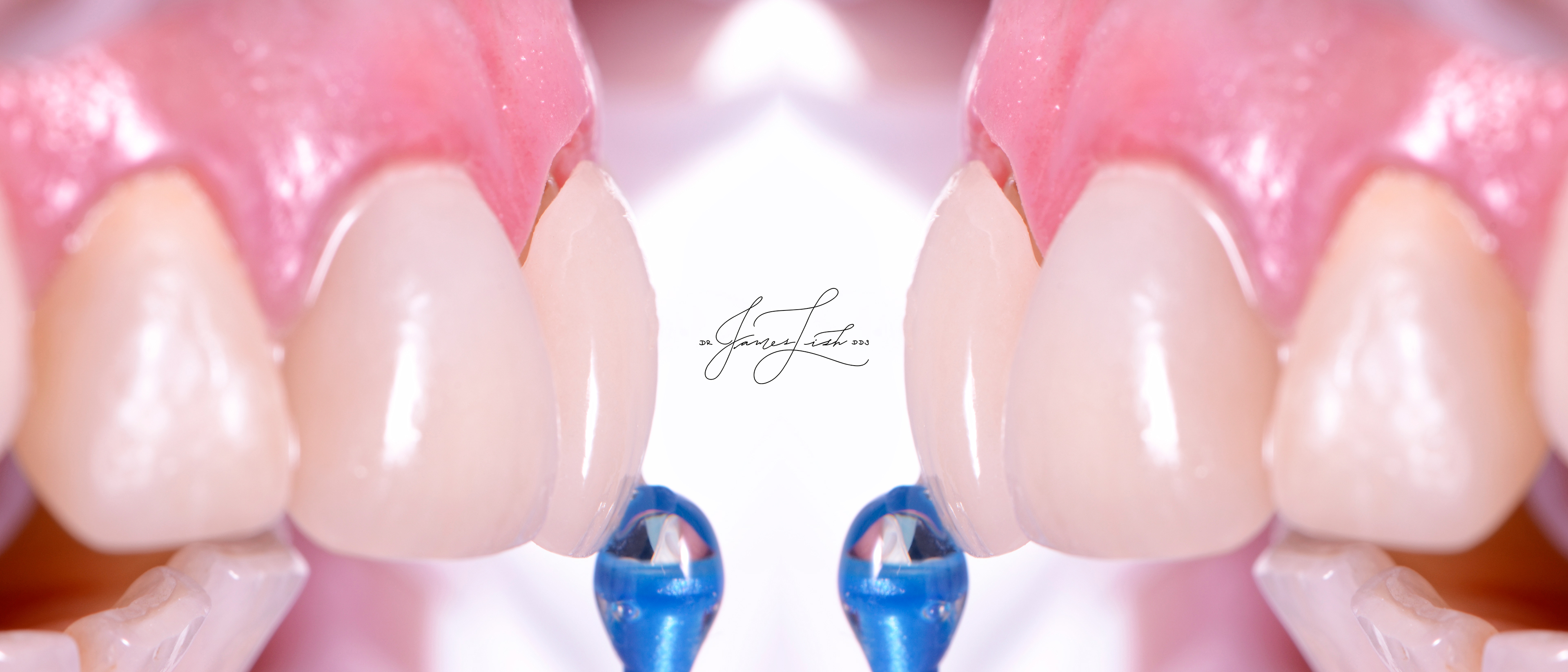 Crown try-in and beautiful tissue health