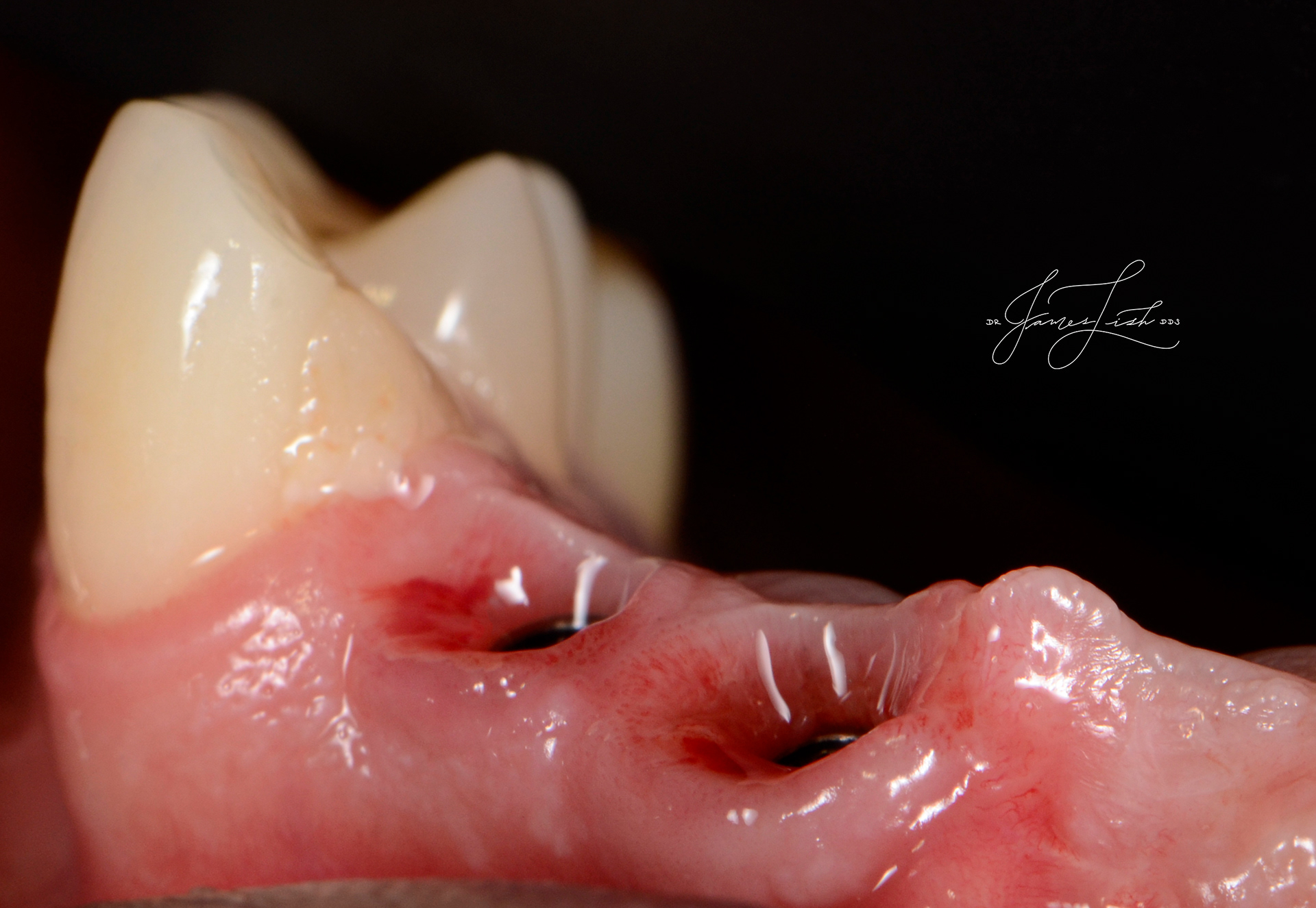 Beautiful tissue healing and contours