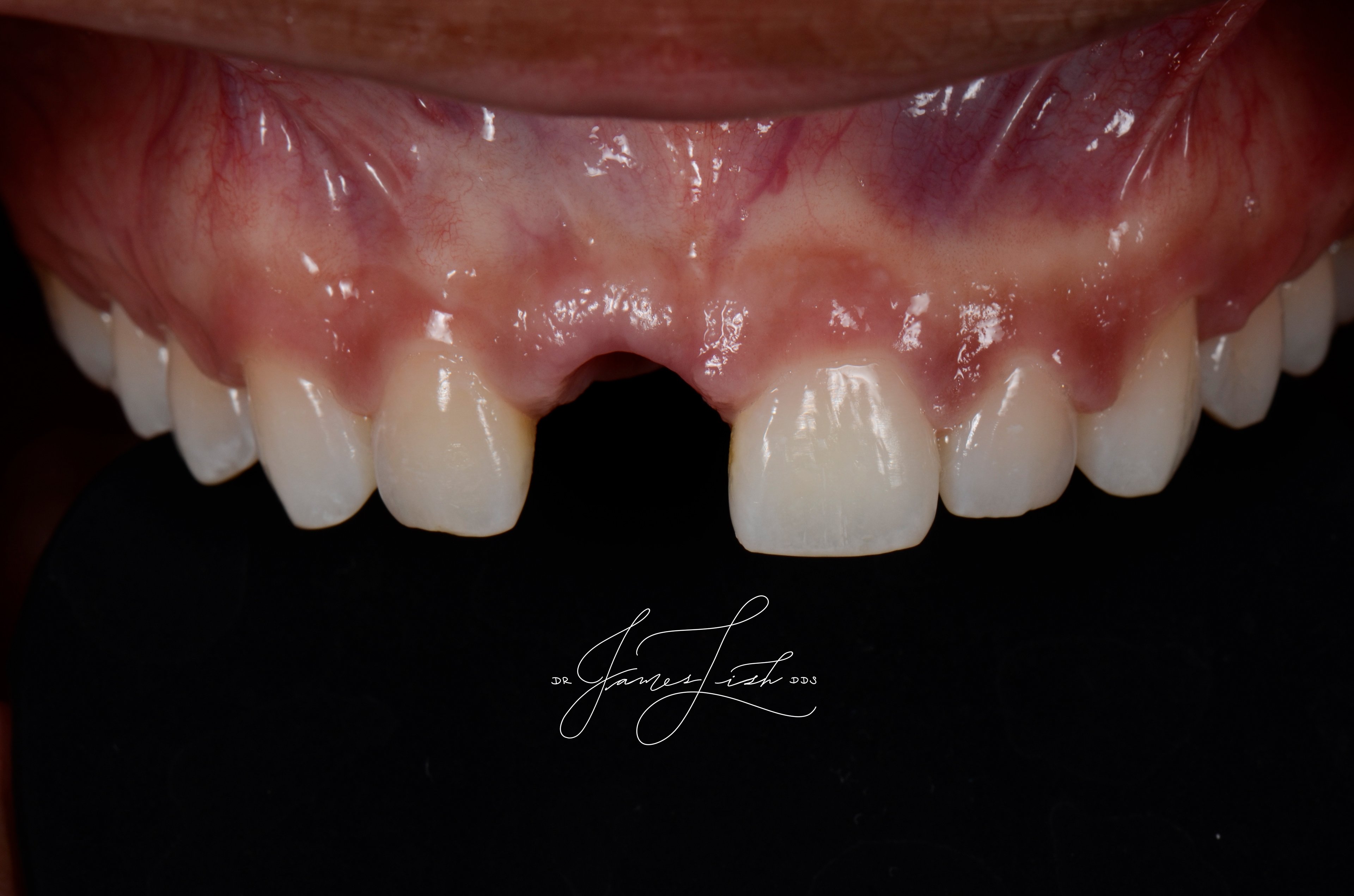 Tissue shaping and maturation