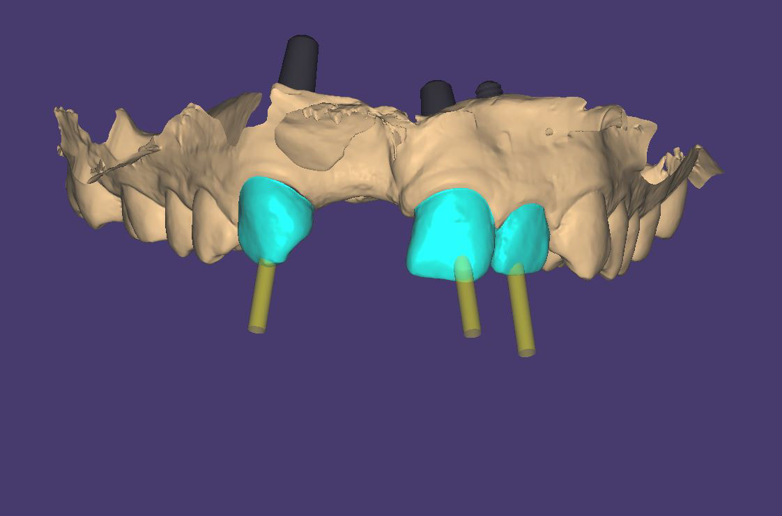 Initial Situation - 3D Scanned. Original teeth are in blue