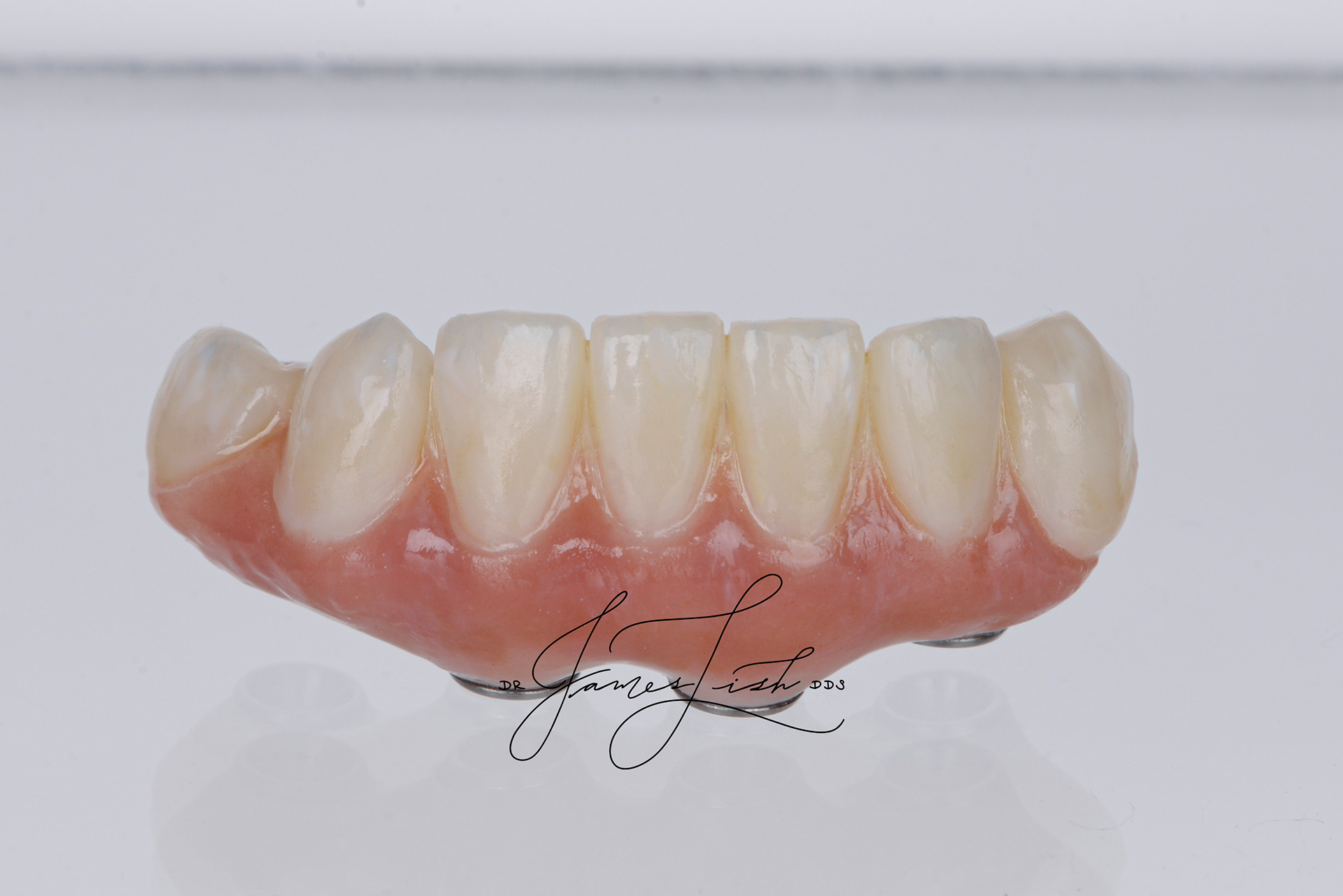 Final ceramic reconstruction