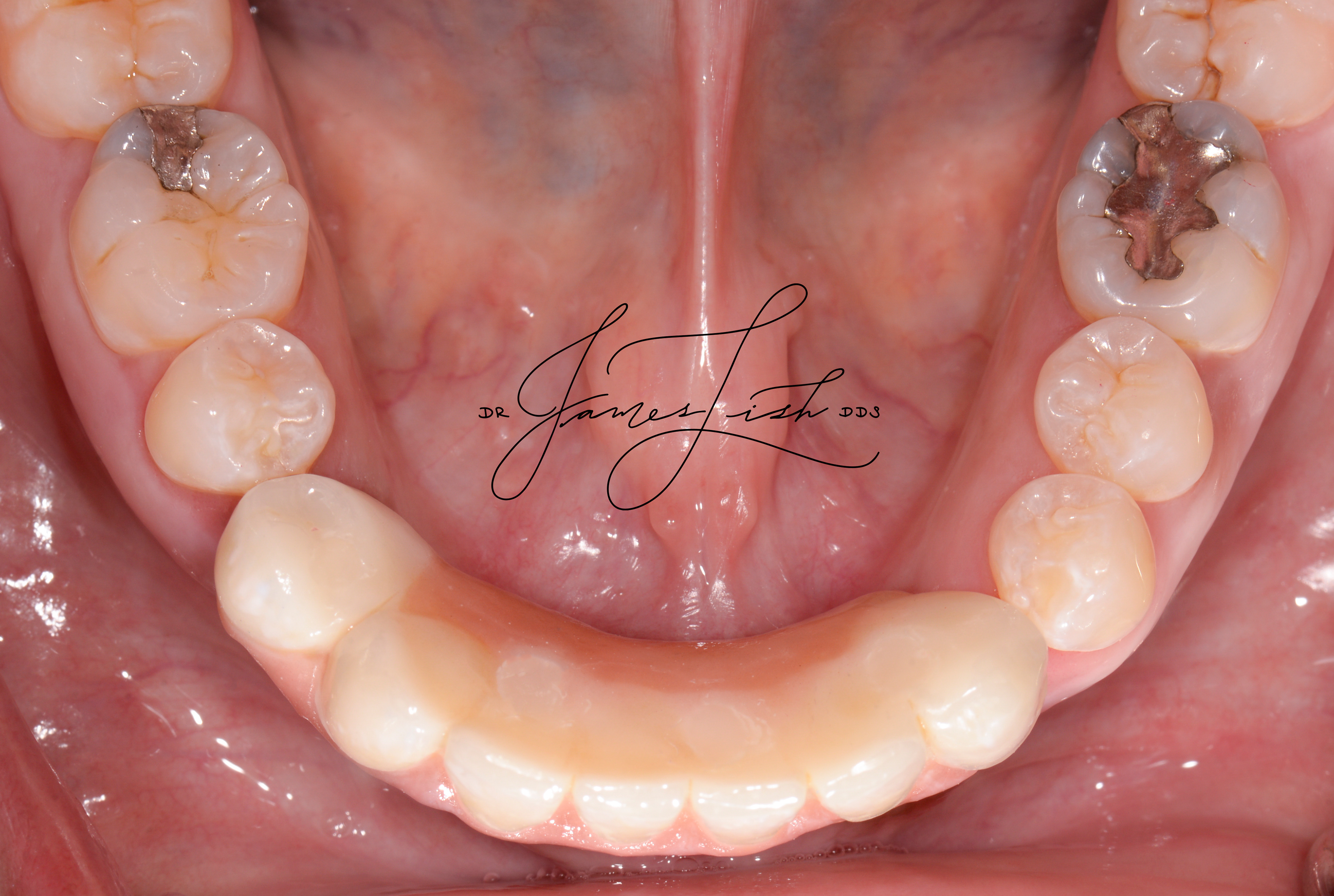 Final ceramic reconstruction