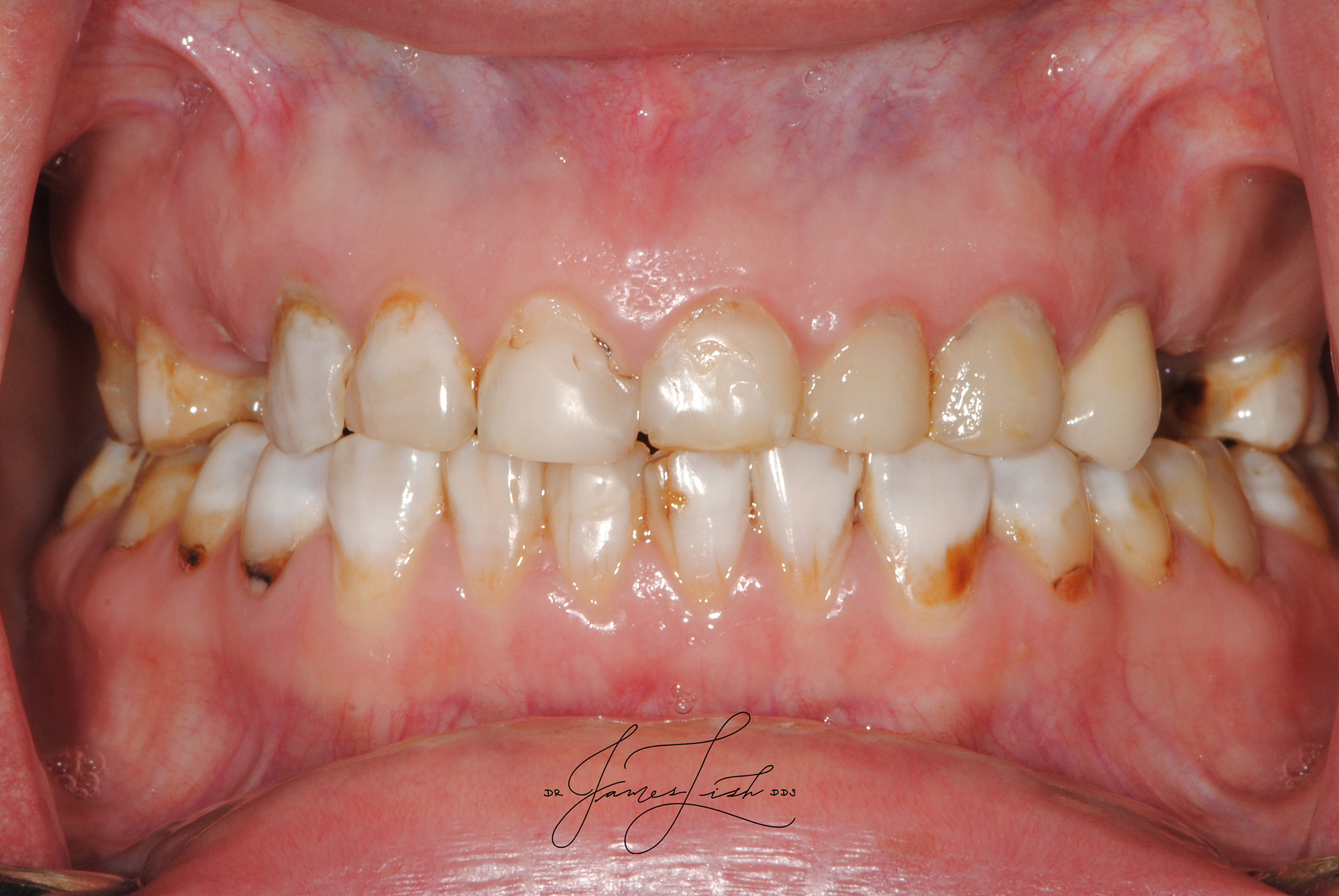 Initial Intra-Oral Condition