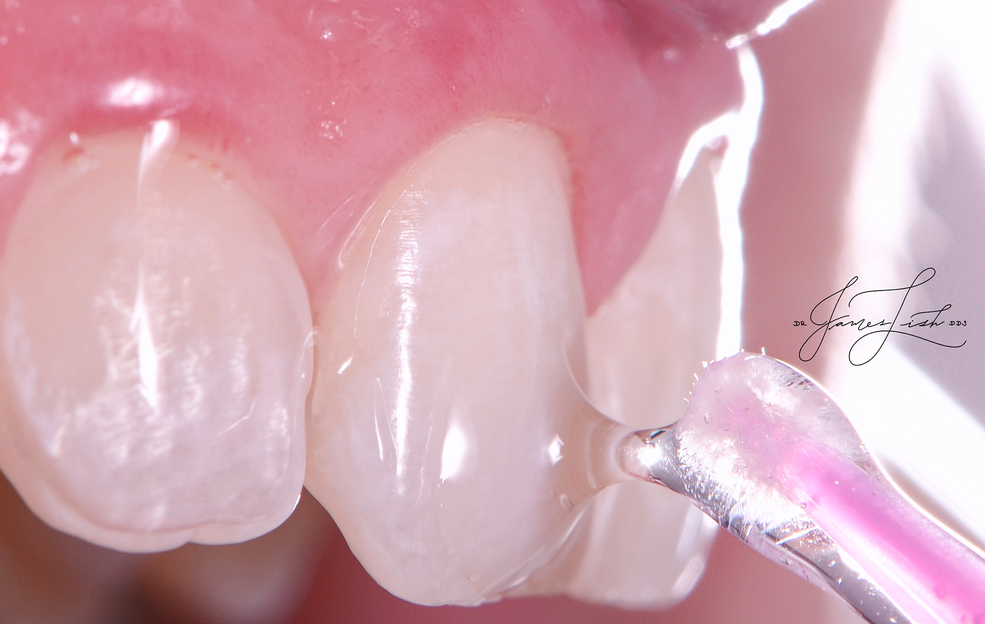 Final curing step for veneers