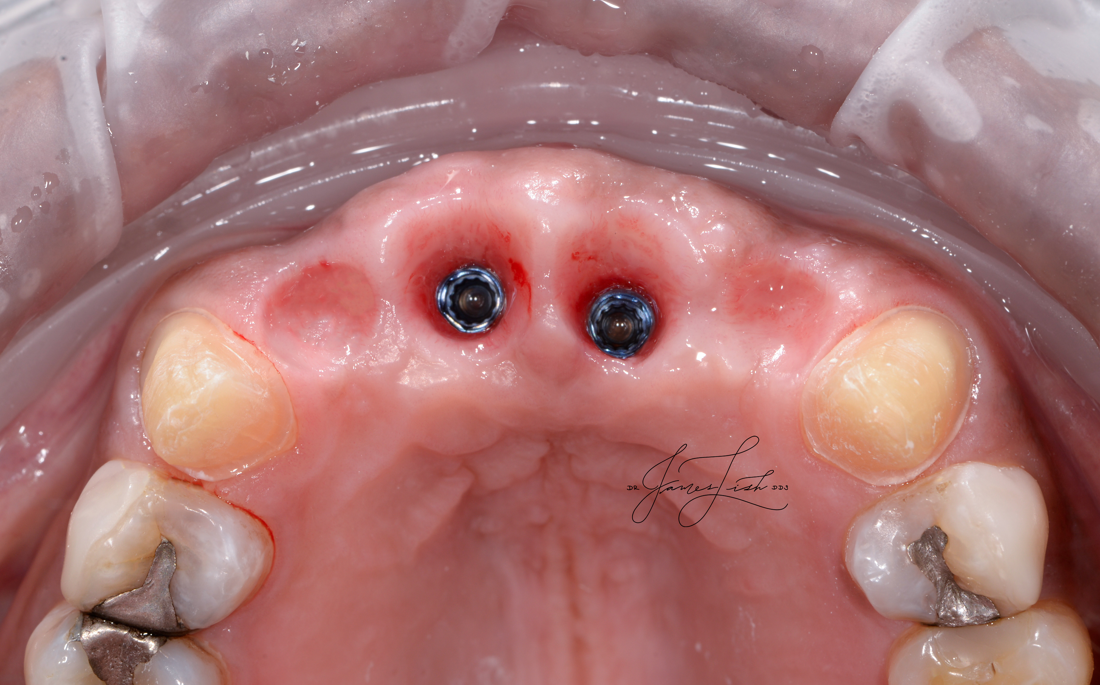 Maxillary Healthy Implant and Tissue Sites