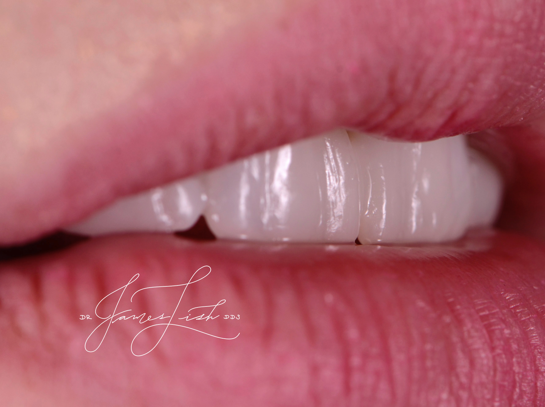 Texture of temporary veneers - Wow