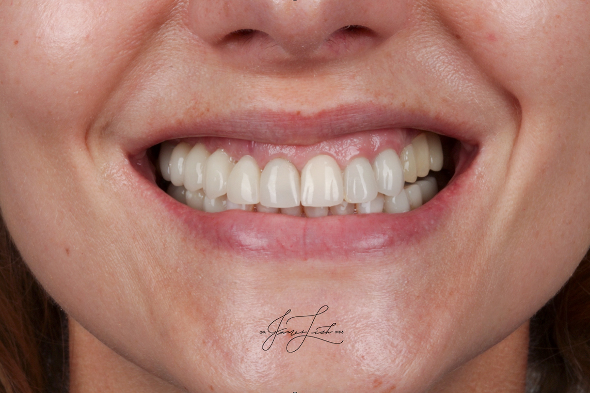 Final Prototypes with Teeth and Dental Implants