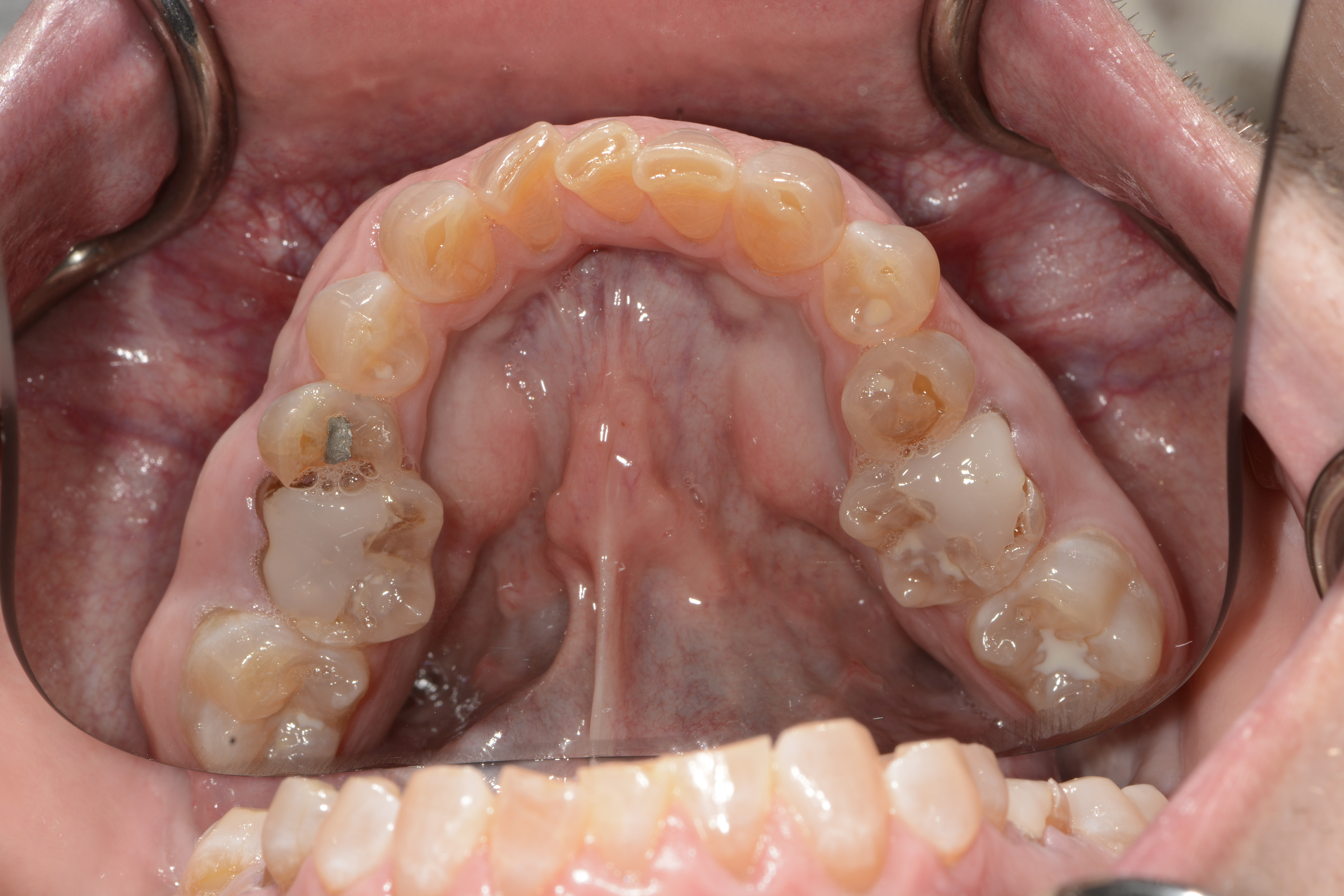 Initial Lower Arch