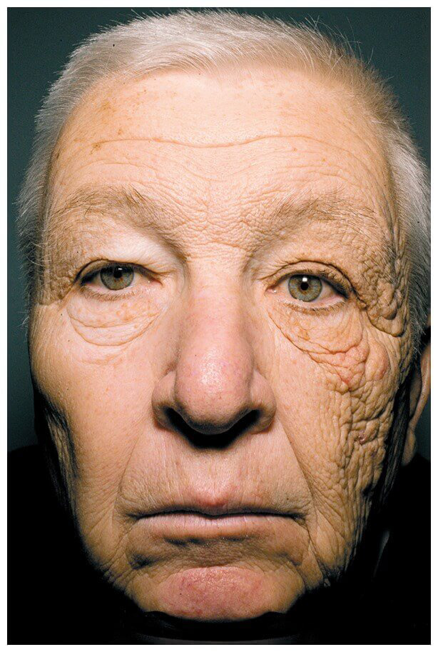 Bill McElligott_Er fuhr als Trucker mehr als 28 Jahren einen Milch-Laster durch die USA. Jeden Tag setzte er am Steuer seine linke Gesichtshälfte für viele Stunden ungeschützt der Sonne aus, die durch das Fenster schien. Die rechte war stets im Schatten. Die eine Gesichtshälfte wirkt um Jahre älter als die andere.