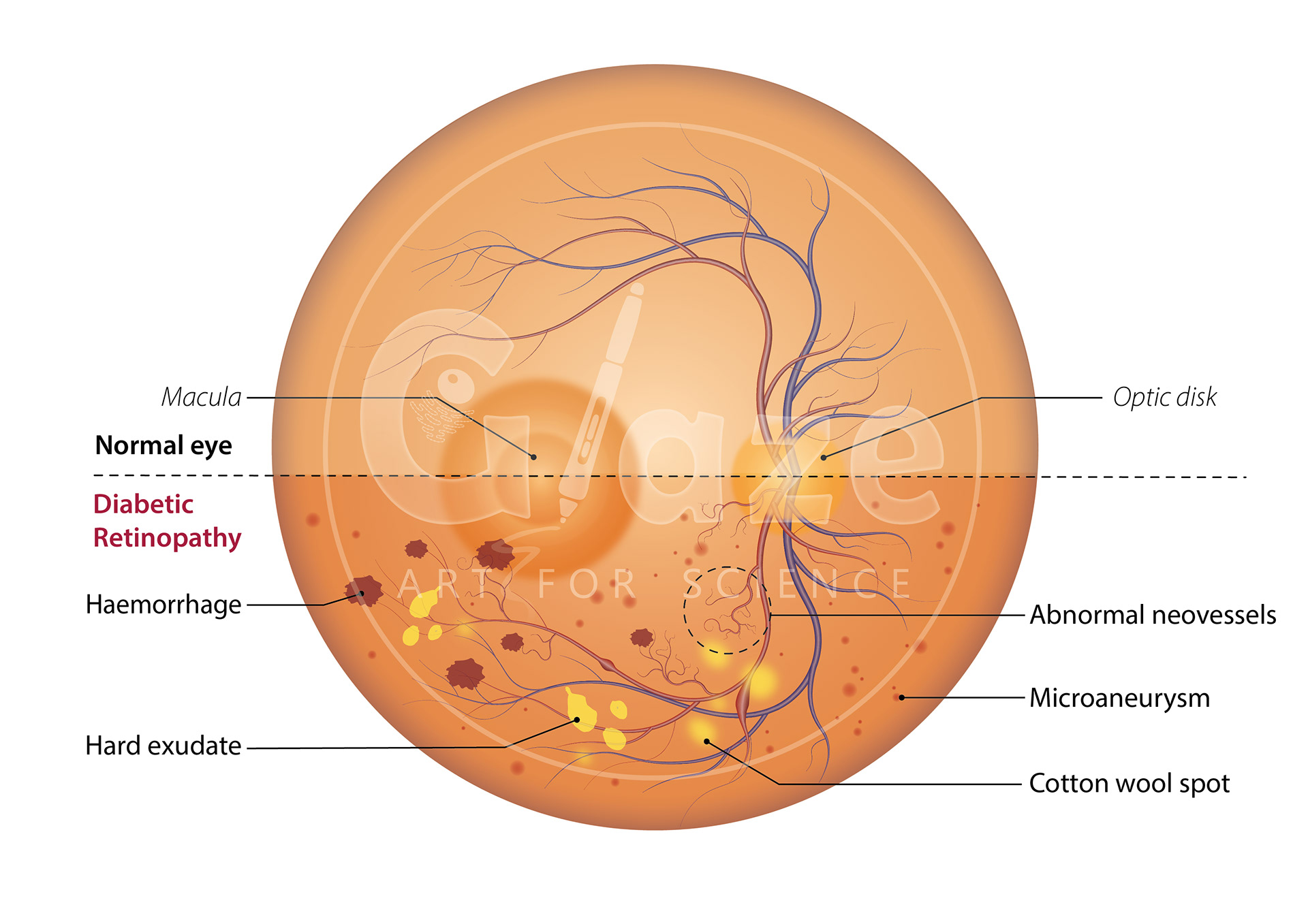 Retina: normal eye vs diabetic retinopathy. From: Bioengineering an Optimised in vitro Model of the Outer Blood-Retinal Barrier Under Diabetic-like Conditions for the Screening of Novel Pharmacological Formulations for Diabetic Retinopathy (2023), PhD thesis, University of Liverpool.