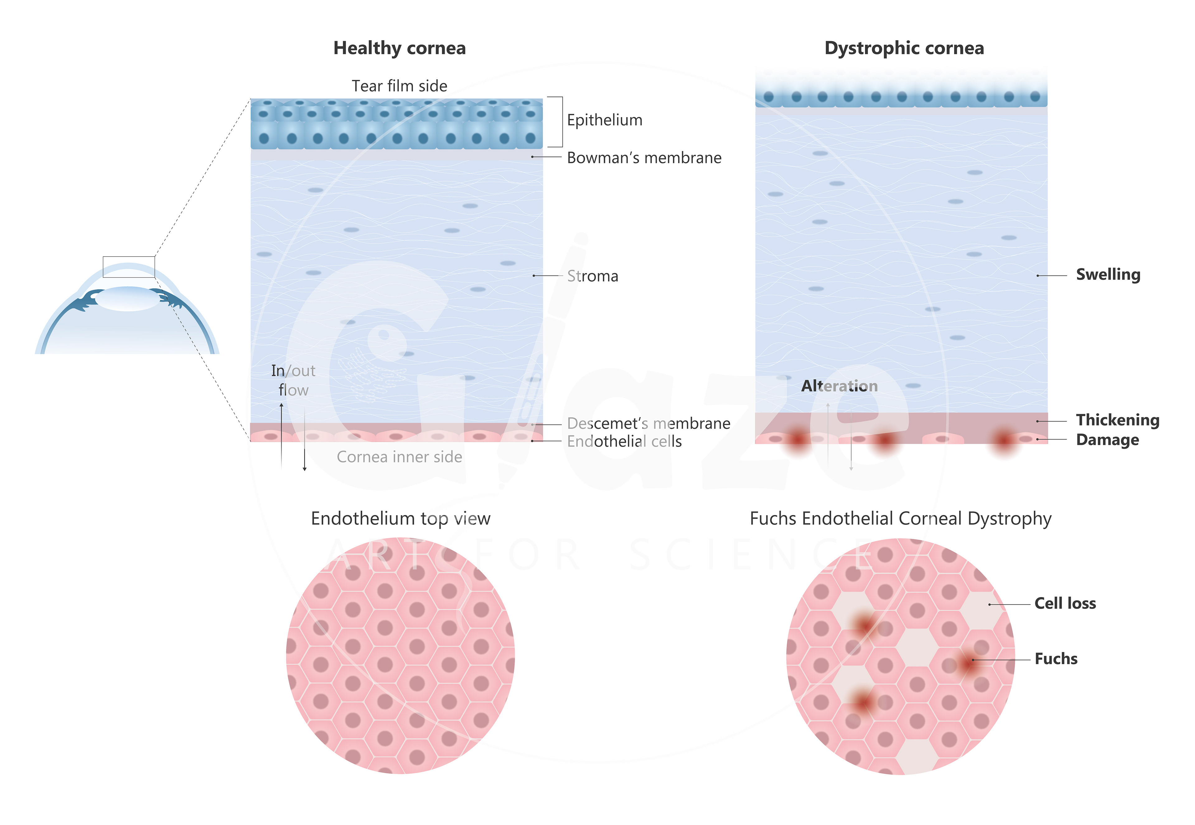 Healthy vs distrophic cornea (human)