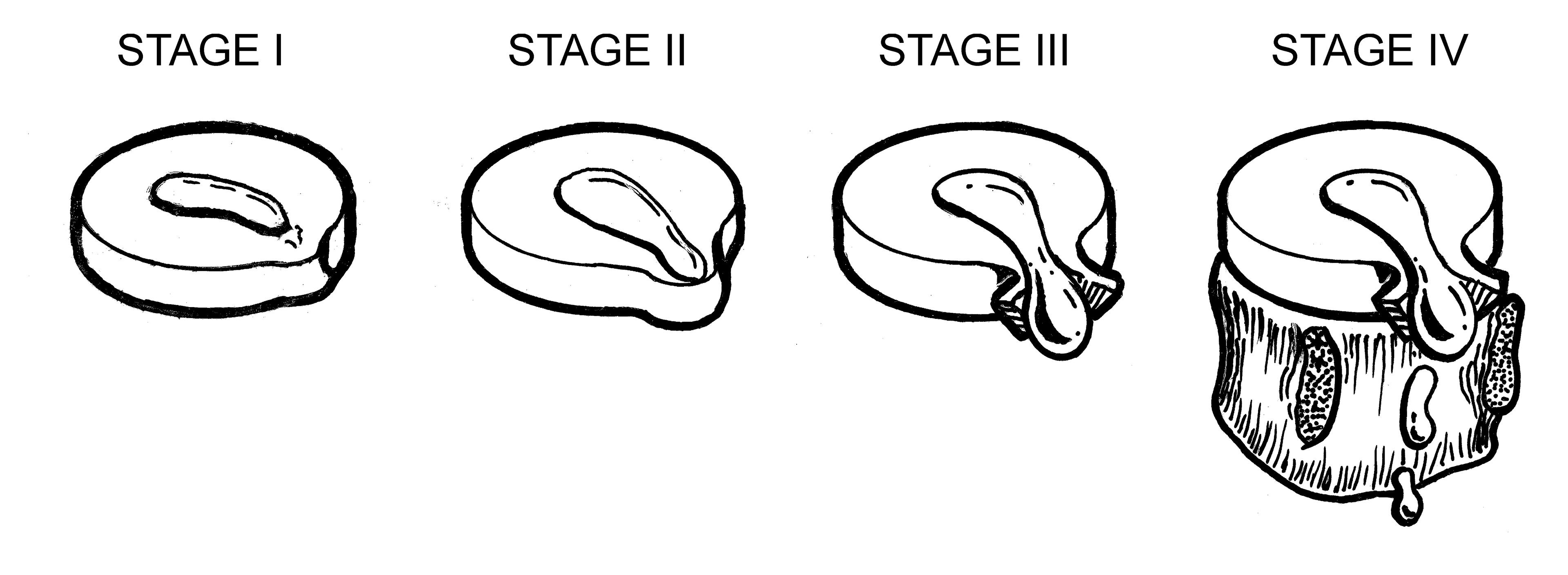 Spinal Anatomy and pathologies