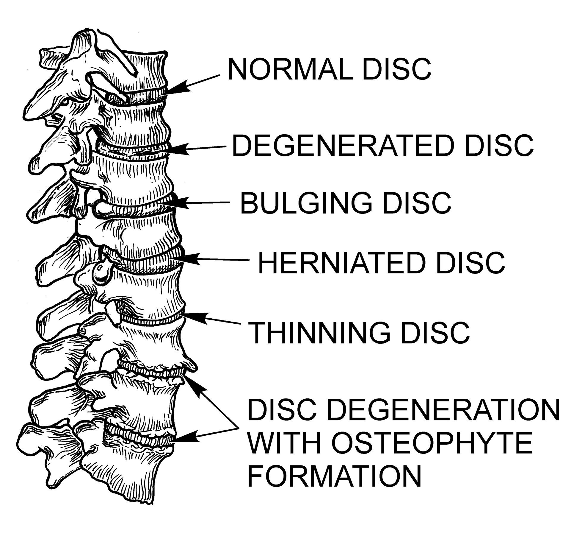 Spinal Anatomy and pathologies