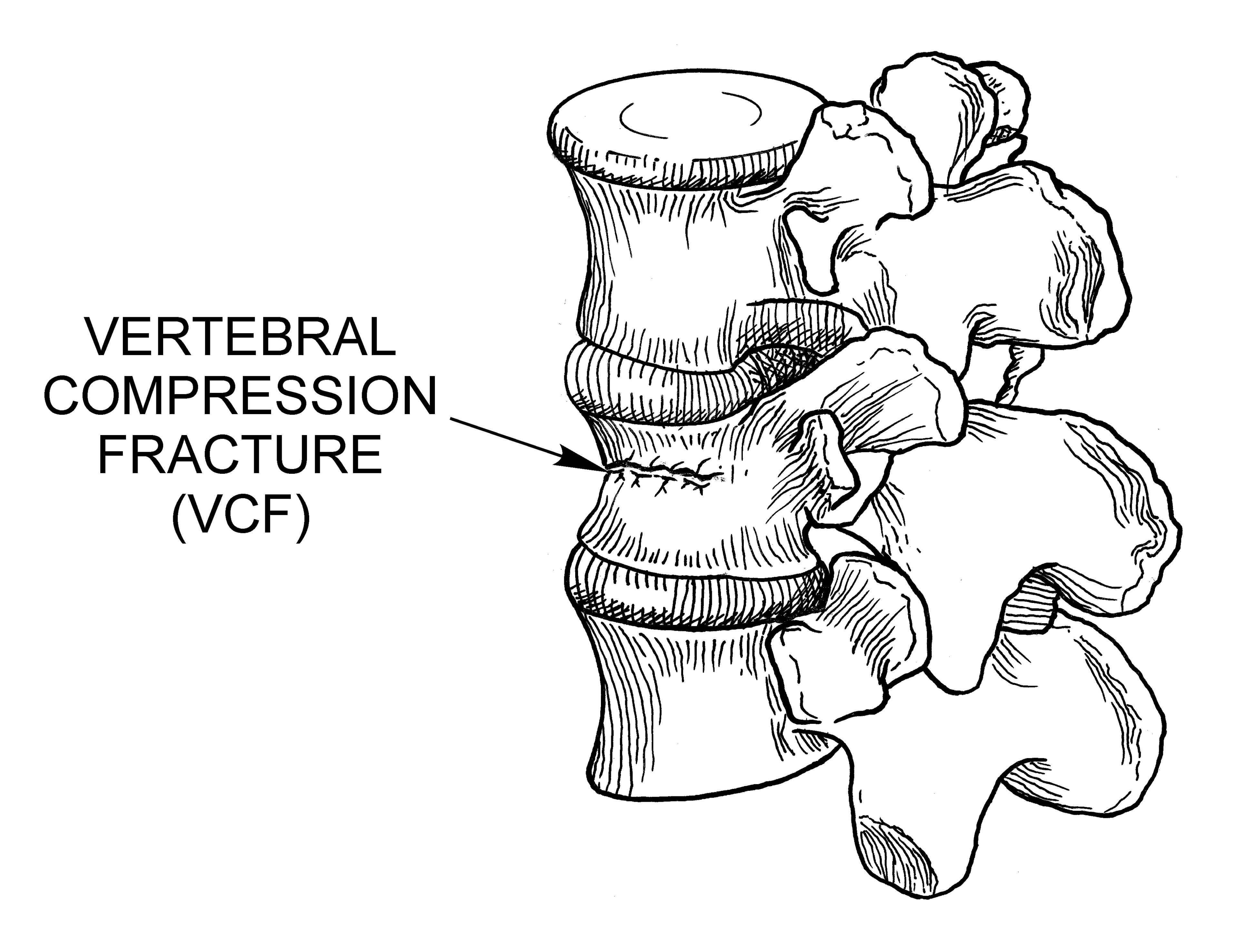 Spinal Anatomy and pathologies