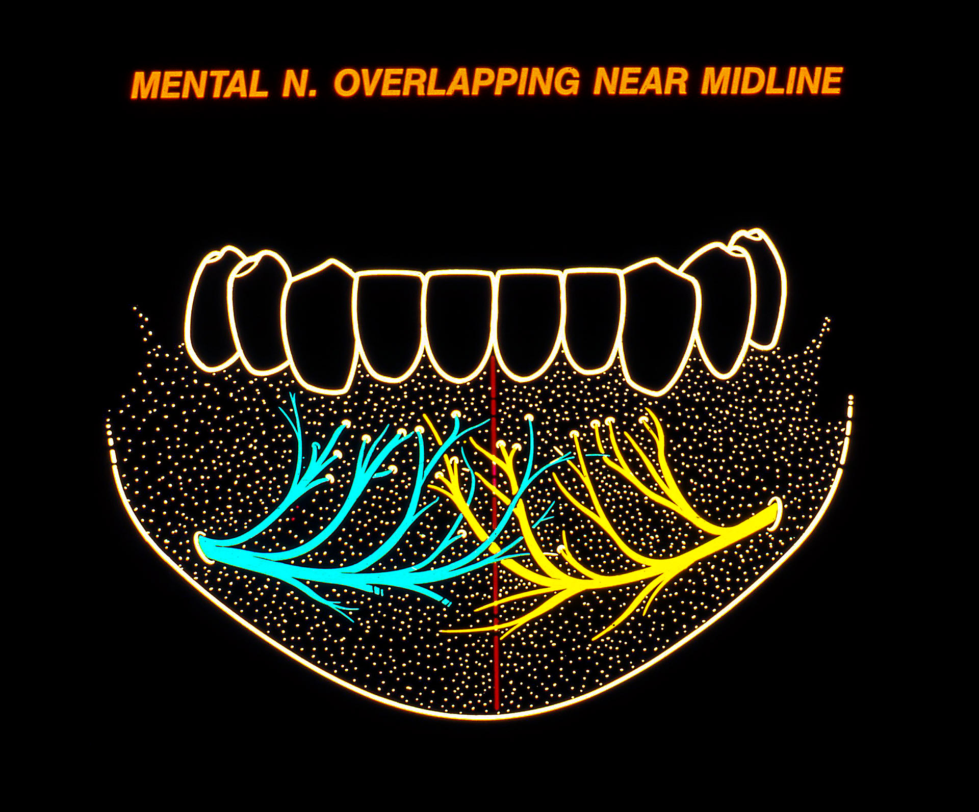 Mandibular Nerve Anatomical Variations