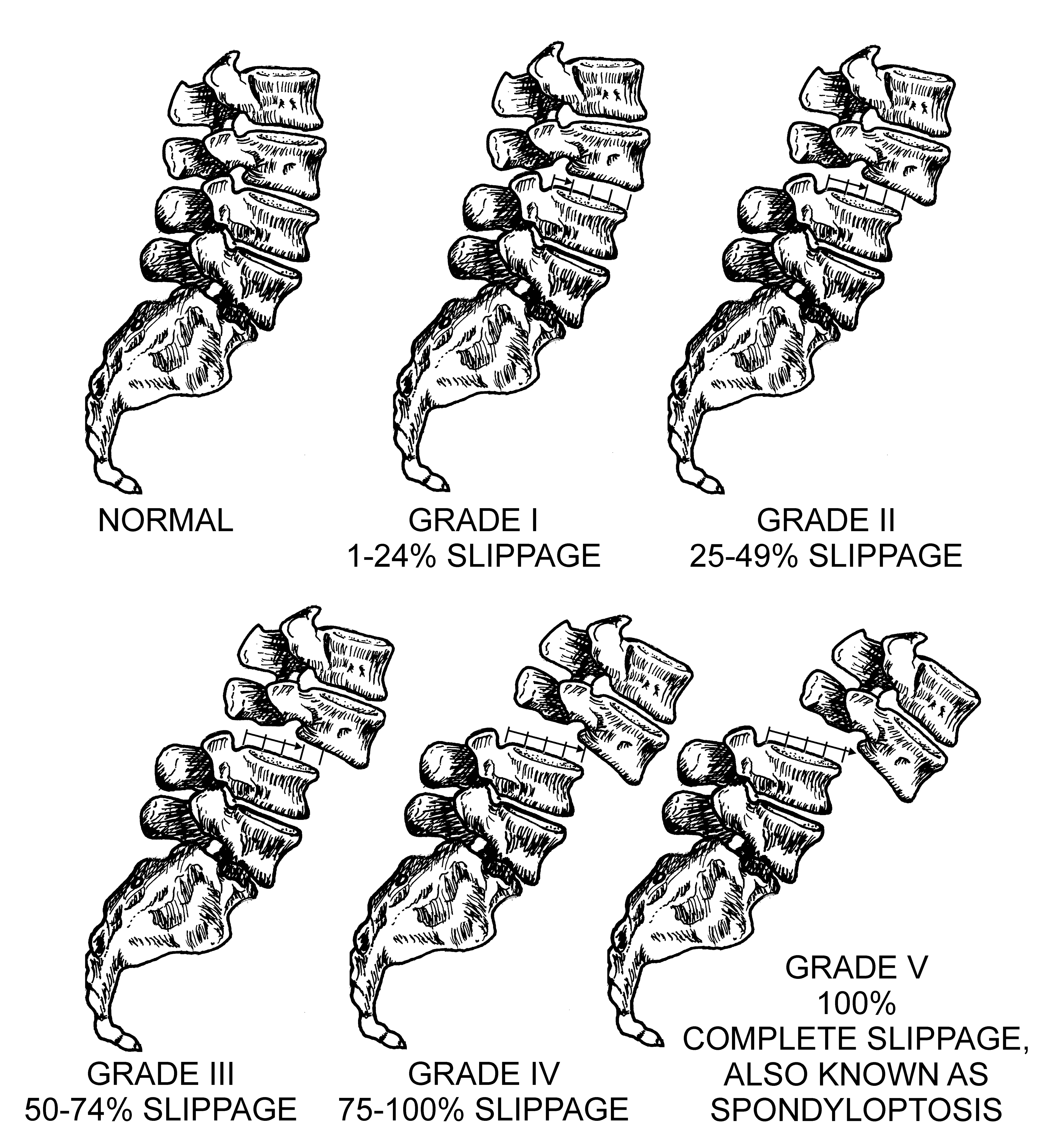 Spinal Anatomy and pathologies